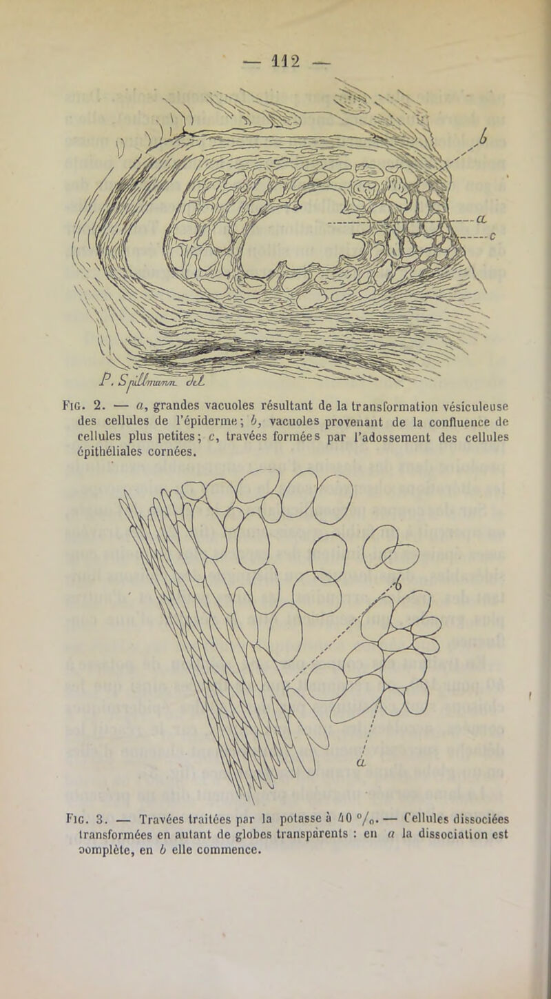 1J2 Fig. 2. — a, grandes vacuoles résultant de la transformation vésiculeuse des cellules de l’épiderme ; b, vacuoles provenant de la confluence de cellules plus petites; c, travées formées par l’adossement des cellules épithéliales cornées. Fig. 3. — Travées traitées par la potasse à éO “/o*— Cellules dissociées transformées en autant de globes transparents : en a la dissociation est oomplète, en b elle commence.