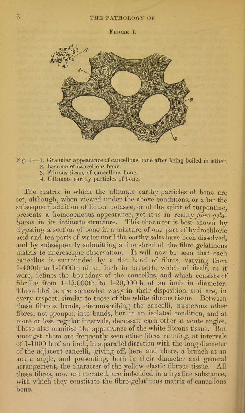 0 FlGUIlE I. Fig. I.—1. Granular appearance of cancellous bone after being boiled in lether. 2. Lacunae of cancellous bone. 3. Fibrous tissue of cancellous bone. 4. Ultimate earthy particles of bone. The matri.x in which the ultimate earthy particles of bone are set, although, when viewed under the above conditions, or after the subsequent addition of liquor potassse, or of the spirit of turpentine, presents a homogeneous appearance, yet it is in reality jihi'o-gela- tinous in its intimate structure. This character is best shown by digesting a section of bone in a mixture of one part of hydrochloric acid and ten parts of water until the earthy salts have been dissolved, and by subsequently submitting a fine shred of the fibro-gelatinous matrix to microscopic observation. It will now be seen that each cancellus is surrounded by a flat band of fibres, varying from l-400th to 1-lOOOth of an inch in breadtli, which of itself, as it were, defines the boundary of the cancellus, and which consists of fibrillm from l-15,000th to 1-20,000th of an inch in diameter. These fibrillae are somewhat wavy in their disposition, and are, in every respect, similar to those of the white fibrous tissue. Between these fibrous bands, circumscribing the cancel! i, numerous other fibres, not grouped into bands, but in an isolated condition, and at more or less regular intervals, decussate each other at acute angles. These also manifest the appearance of the white fibrous tissue. But amongst them are frequently seen other fibres running, at intervals of 1-1000th of an inch, in a parallel direction with the long diameter of the adjacent cancelli, giving off, here and there, a branch at an acute angle, and presenting, both in their diameter and general arrangement, the character of the yellow elastic fibrous ti.ssuc. All these fibre.s, now enumerated, are imbedded in a hyaline substance, with which they constitute the fibro-gelatinous matrix of cancellous bone.