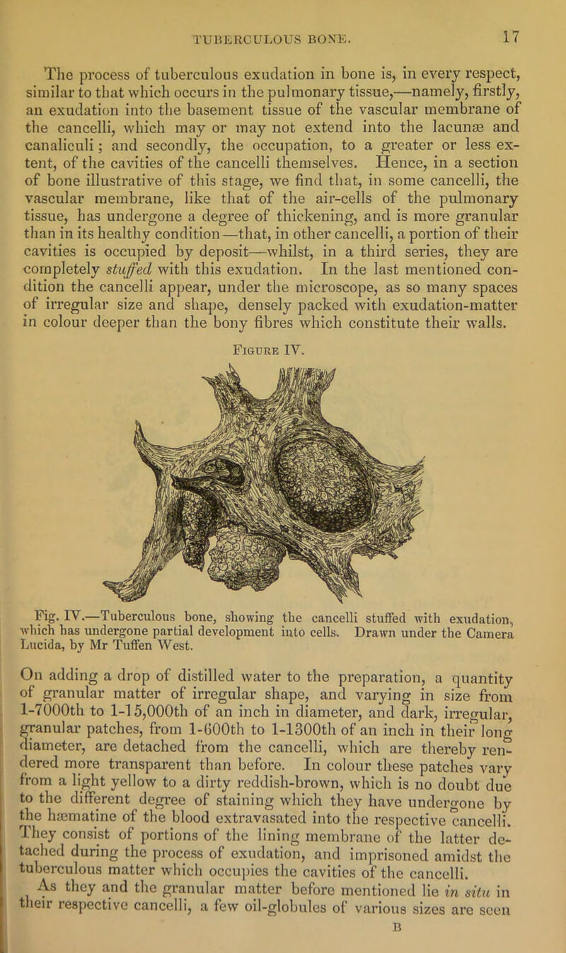 The process of tuberculous exudation in bone is, in every respect, similar to that which occurs in the pulmonary tissue,—namely, firstly, an exudation into the basement tissue of the vascular membrane of the cancelli, which may or may not extend into the lacunae and canaliculi; and secondly, the occupation, to a gi’eater or less ex- tent, of the cavities of the cancelli themselves. Hence, in a section of bone illustrative of this stage, we find that, in some cancelli, the vascular membrane, like that of the air-cells of the pulmonary tissue, has undergone a degree of thickening, and is more granular than in its healthy condition—that, in other cancelli, a portion of their cavities is occupied by deposit—whilst, in a third series, they are completely stuffed with this exudation. In the last mentioned con- dition the cancelli appear, under the microscope, as so many spaces of irregular size and shape, densely packed with exudation-matter in colour deeper than the bony fibres which constitute their walls. Figuke IV. Fig. IV.—Tuberculous bone, showing the cancelli stuffed with exudation, which has undergone partial development into cells. Drawn under the Camera Lucida, by Mr Tuffen West. On adding a drop of distilled water to the preparation, a quantity of granular matter of irregular shape, and varying in size from 1-7000th to 1-15,000th of an inch in diameter, and dark, irregular, granular patches, from 1-GOOth to l-1300th of an inch in their lono- fliameter, are detached from the cancelli, which are thereby ren- dered more transparent than before. In colour these patches vary from a light yellow to a dirty reddish-brown, which is no doubt due to the different degree of staining which they have undergone by the hajmatine of the blood extravasated into the respective cancelli. They consist of portions of the lining membrane of the latter de- tached during the process of exudation, and imprisoned amidst the tuberculous matter which occupies the cavities of the cancelli. As they and the granular matter before mentioned lie in situ in t leir respective cancelli, a few oil-globules of various sizes are seen B