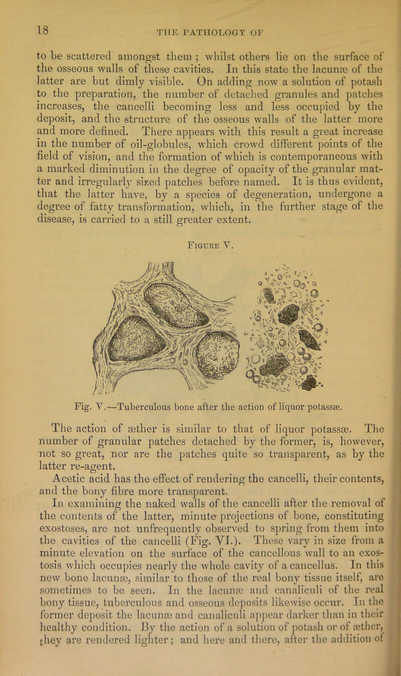 to be scattered amongst them ; wliilst others lie on tlie surface of tlie osseous walls of these cavities. In this state the lacunae of the latter are but dimly visible. On adding now a solution of potash to the preparation, the number of detached granules and patches increases, the cancelli becoming less and less occupied by the deposit, and the structure of the osseous walls of the latter more and more defined. There appears with this result a great increase in the number of oil-globules, which crowd different points of the field of vision, and the formation of which is contemporaneous with a marked diminution in the degree of opacity of the granular mat- ter and irregularly sized patches before named. It is thus evident, that the latter have, by a species of degenei’ation, undergone a degree of fatty transformation, which, in the further stage of the disease, is carried to a still greater extent. Figure V. Fig. V,—Tuberculous bone after the action of liquor potassie. The action of sether is similar to that of liquor potassaj. The number of granular patches detached by the former, is, however, not so great, nor are the patches quite so transparent, as by the latter re-agent. Acetic acid has the effect of rendering the cancelli, their contents, , and the bony fibre more transparent. In examining the naked walls of the cancelli after the removal of the contents of the latter, minute projections of bone, constituting exostoses, are not unfrequently observed to spring from them into the cavities of the cancelli (Fig. VI.). These vaiy in size from a minute elevation on the surface of the cancellous wall to an exos- tosis which occupies nearly the whole cavity of a cancellus. In this new bone lacume, similar to those of the real bony tissue itself, are sometimes to be seen. In the lacunm and canaliculi of the real bony tissue, tuberculous and osseous deposits likewise occur. In the former deposit the lacunm and canaliculi appear darker than in their healthy condition. By the action of a solution of potash or of aithcr, they are rendered lighter; and hei’e and there, after the addition of
