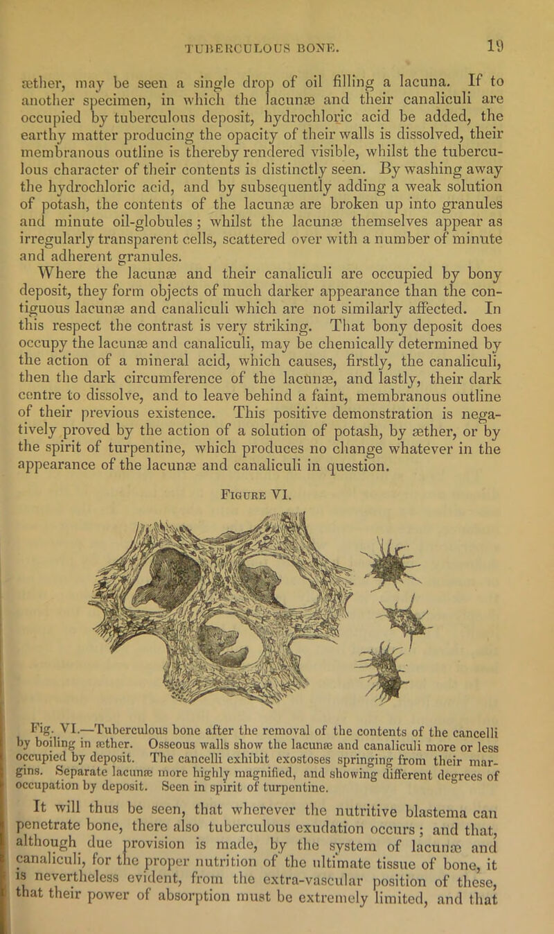 ffitlier, may be seen a single drop of oil filling a lacuna. If to another specimen, in which the lacunre and their canaliculi are occupied by tuberculous deposit, hydi’ochloric acid be added, the earthy matter producing the opacity of their walls is dissolved, their membranous outline is thereby rendered visible, whilst the tubercu- lous character of their contents is distinctly seen. By washing away tlie hydrochloric acid, and by subsequently adding a weak solution of potash, the contents of the lacunae are broken up into granules and minute oil-globules; whilst the lacunae themselves appear as irregularly transparent cells, scattered over with a number of miniite and adherent granules. Where the lacunae and their canaliculi are occupied by bony deposit, they form objects of much darker appearance than the con- tiguous lacunae and canaliculi which ai’e not similarly affected. In this respect the contrast is very striking. That bony deposit does occupy the lacunae and canaliculi, may be chemically determined by the action of a mineral acid, which causes, firstly, the canaliculi, then the dark circumfex’ence of the lacunae, and lastly, their dark centre to dissolve, and to leave behind a faint, membranous outline of their previous existence. This positive demonstration is nega- tively proved by the action of a solution of potash, by aether, or by the spirit of turpentine, which produces no change whatever in the appearance of the lacunae and canaliculi in question. Figure VI. Fig; VI.—Tuberculous bone after the removal of the contents of the cancelli by boiling in a;thcr. Osseous walls show the lacunic and canaliculi more or less occupied by deposit. The cancelli exhibit exostoses springing from their mar- gins. Separate lacimse more highly magnified, and showing different decrees of occupation by deposit. Seen in spirit of turpentine. It will thus be seen, that wherever the nutritive blastema can penetrate bone, there also tuberculous exudation occurs ; and that, although due nrovision is made, by the system of lacuntc and canaliculi, for the proper nutrition of the ultimate tissue of bone, it evident, from the e.xtra-vascular position of these, that their power of absorption must be extremely limited, and that