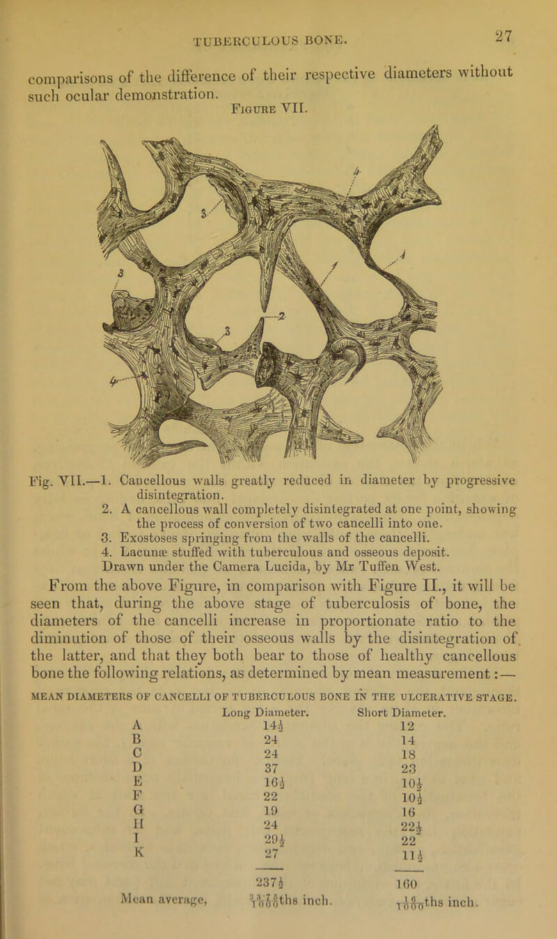 comparisons of the difterence of their respective diameters without sucli ocular demonstration. Figube VII. Fig. VII.—1. Cancellous walls greatly reduced in diameter by progressive disintegration. 2. A cancellous wall completely disintegrated at one point, showing the process of conversion of two cancelli into one. 3. Exostoses springing from the walls of the cancelli. 4. Lacunoe stuffed with tuberculous and osseous deposit. Drawn under the Camera Lucida, by Mr Tuffen West. From the above Figure, in comparison with Figure II., it will be seen that, during the above stage of tuberculosis of bone, the diameters of the cancelli increase in proportionate ratio to the diminution of those of their osseous walls by the disintegration of, the latter, and that they both bear to those of healthy cancellous bone the following relations, as determined by mean measurement:— MEAN DIAMETERS OF CANCELLI OF TUBERCULOUS BONE IN THE ULCERATIVE STAGE. A B C D E F a II I K Long Diameter. Short Diameter. I4i 12 24 14 24 18 37 23 16.i lOi 22 104 19 16 24 22^ 29i 22 27 114 2374 160 * rtX^t’hs inch. y^lhyfbs inch. Mean average,