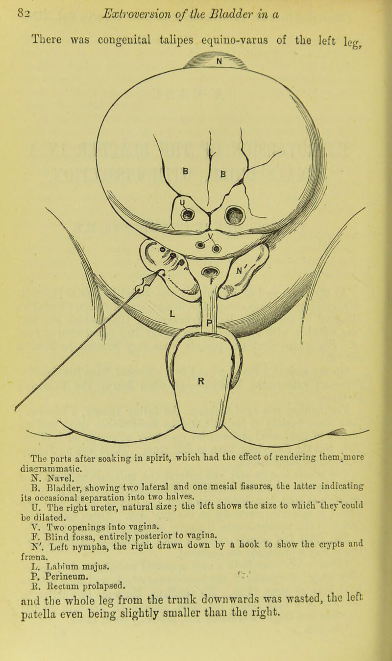 There was congenital talipes equino-varus of the left leg^ The parts after soaking in spirit, which had the effect of rendering them^more diaerranimatic. N. Navel. B. Bladder, showing two lateral and one mesial fissures, the latter indicating its occasional separation into two halves. U. The right ureter, natural size ; the left shows the size to whicirthey could be dilated. V. Two openings into vagina. _ F. Blind fossa, entirely posterior to vagina. N'. Left nympha, the right drawn down by a hook to show the crypts and fro3na. L. Labium majus. P. Perineum. 'r' B. Itectum prolapsed. and the whole leg from the trunk downwards was wasted, the left patella even being slightly smaller than the right.