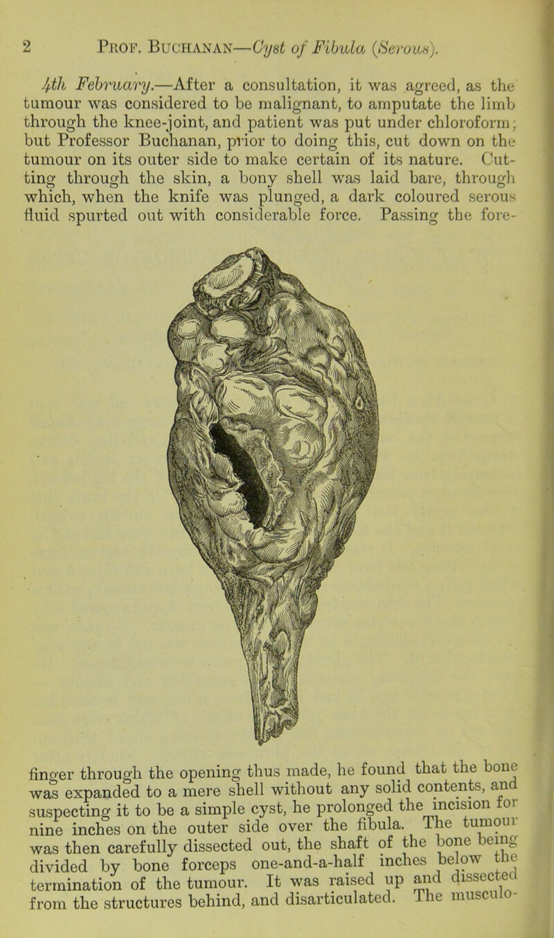 fth February.—After a consultation, it was agreed, as the tumour was considered to be malignant, to amputate the limb through the knee-joint, and patient was put under chloroform; but Professor Buchanan, prior to doing this, cut down on the tumour on its outer side to make certain of its nature. Cut- ting through the skin, a bony shell was laid bare, through which, when the knife was plunged, a dark coloured serous fluid spurted out with considerable force. Passing the fore- finger through the opening thus made, he found that the bone was expanded to a mere shell without any solid contents, anc suspecting it to be a simple cyst, he prolonged the incision tor nine inches on the outer side over the fibula. The tumoui was then carefully dissected out, the shaft of the bone being divided by bone forceps one-and-a-half inches below tne termination of the tumour. It was raised up and dissected from the structures behind, and disarticulated. The musculo-