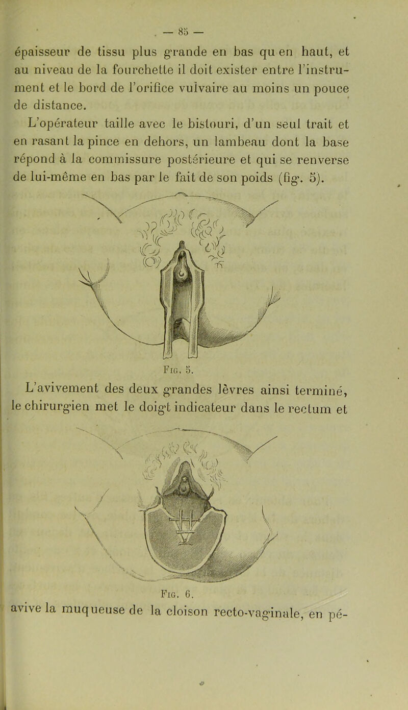 épaisseur de tissu plus grande en bas qu en haut, et au niveau de la fourchette il doit exister entre l’instru- ment et le bord de l’orifice vulvaire au moins un pouce t de distance. L’opérateur taille avec le bistouri, d’un seul trait et en rasant la pince en dehors, un lambeau dont la base répond à la commissure postérieure et qui se renverse de lui-même en bas par le fait de son poids (fig\ 5). L’avivement des deux grandes lèvres ainsi terminé, le chirurgien met le doigd indicateur dans le rectum et Fig. 6. avive la muqueuse de la cloison recto-vaginale, en pé O 1