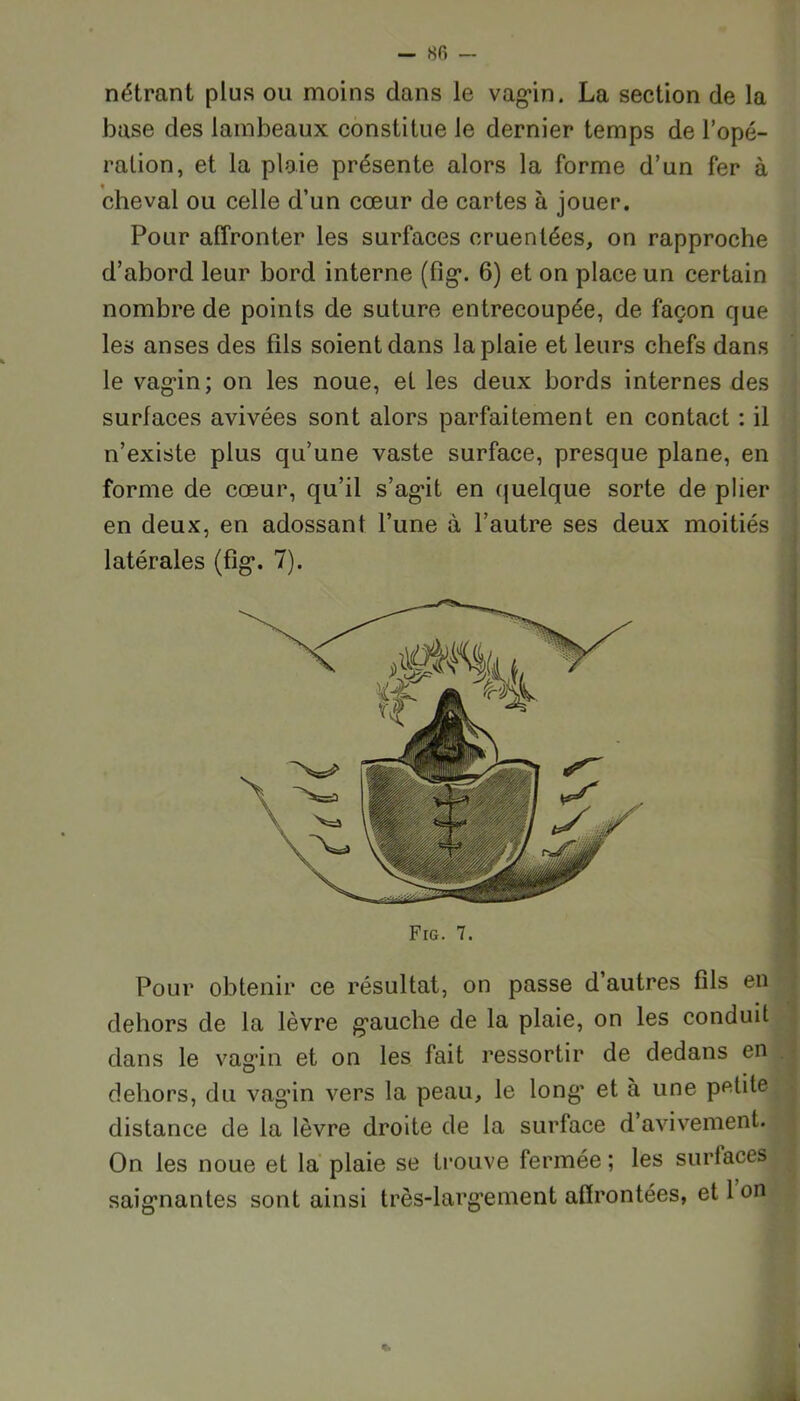 - 8<î nétrant plus ou moins dans le vagin. La section de la base des lambeaux constitue le dernier temps de l’opé- ration, et la ploie présente alors la forme d’un fer à cheval ou celle d’un cœur de cartes à jouer. Pour affronter les surfaces cruenlées, on rapproche d’abord leur bord interne (fig. 6) et on place un certain nombre de points de suture entrecoupée, de façon que les anses des fils soient dans la plaie et leurs chefs dans le vagin; on les noue, et les deux bords internes des surfaces avivées sont alors parfaitement en contact : il n’existe plus qu’une vaste surface, presque plane, en forme de cœur, qu’il s’agit en quelque sorte de plier en deux, en adossant l’une à l’autre ses deux moitiés latérales (fig. 7). Fig. 7. Pour obtenir ce résultat, on passe d’autres fils en dehors de la lèvre gauche de la plaie, on les conduit dans le vagin et on les fait ressortir de dedans en dehors, du vagin vers la peau, le long’ et à une petite distance de la lèvre droite de la surface d’avivement. On les noue et la plaie se trouve fermée ; les surfaces saignantes sont ainsi très-largement affrontées, et 1 on