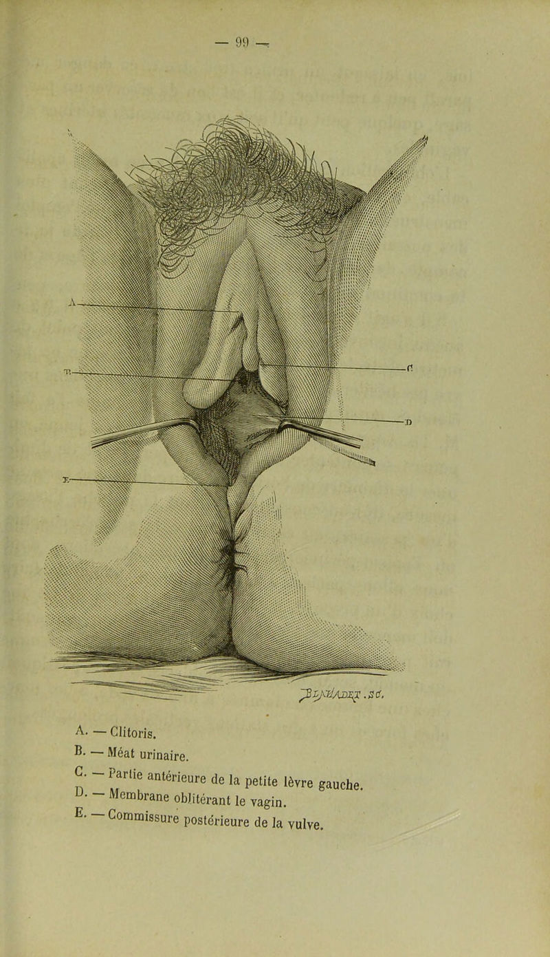 A. — Clitoris. B- Méat urinaire. G- - Partie antérieure de la petite lèvre gauche. U. - Membrane oblitérant le vagin. E- — Commissure postérieure de la vulve.