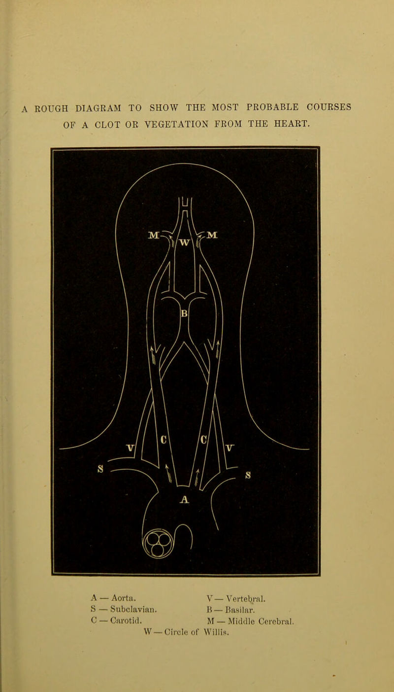 A ROUGH DIAGRAM TO SHOW THE MOST PROBABLE COURSES OF A CLOT OR VEGETATION FROM THE HEART. A — Aortii. V — V ertebrnl. S — Subclavian. li— Basilar. C — Carotid. M — Middle Cerebral. W —Circle of Willis. I