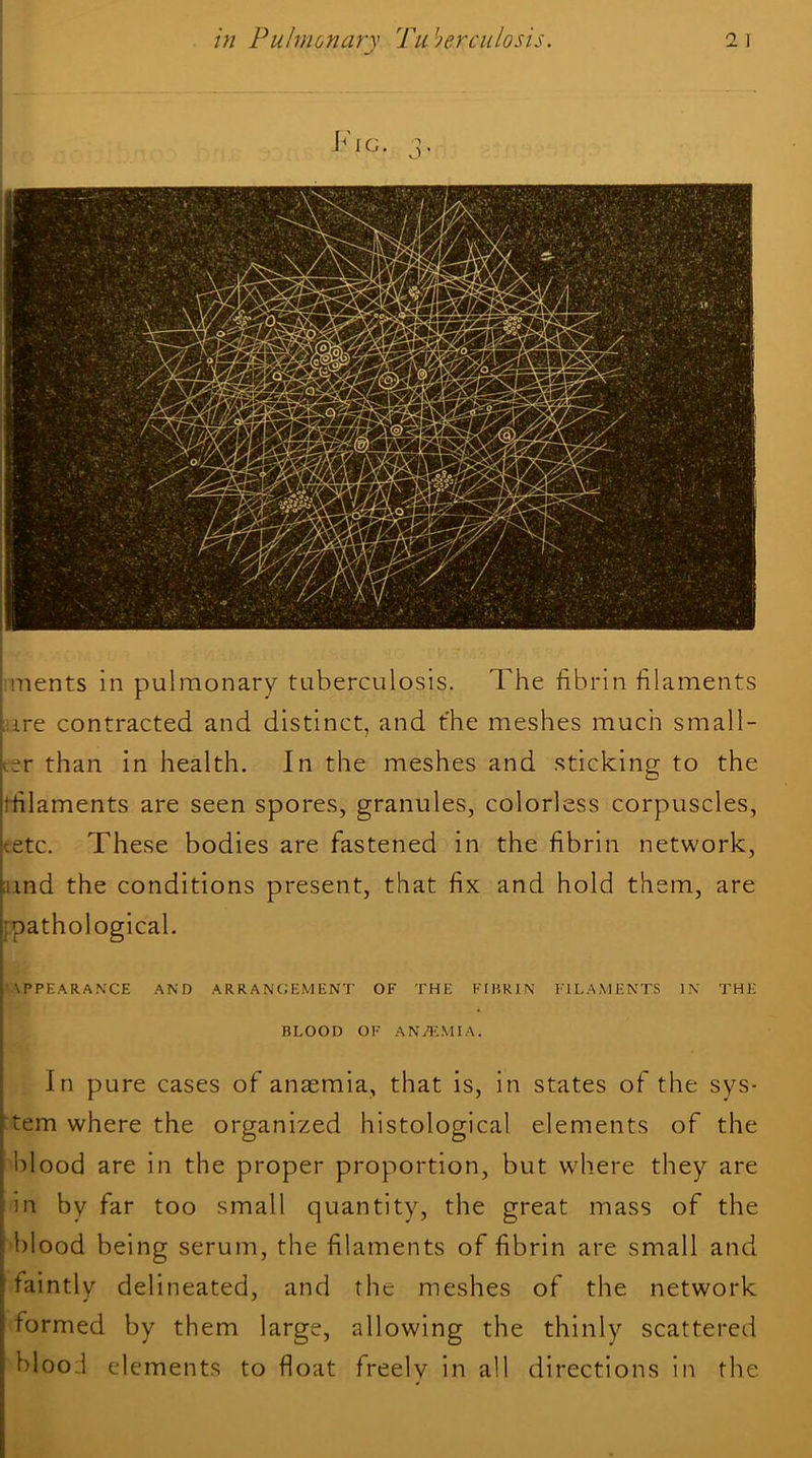 in Pulmonary Tuberculosis. rments in pulmonary tuberculosis. The fibrin filaments ire contracted and distinct, and t'he meshes much small- ::sr than in health. In the meshes and sticking to the ■rfilaments are seen spores, granules, colorless corpuscles, '.etc. These bodies are fastened in the fibrin network, and the conditions present, that fix and hold them, are 'pathological. \PPEARAN’CE AND ARRANGEMENT OF THE FIHRIN F1LAMENT.S IN THE BLOOD OF AN/IGVIIA. In pure cases of anaemia, that is, in states of the sys- tem where the organized histological elements of the blood are in the proper proportion, but where they are in by far too small quantity, the great mass of the blood being serum, the filaments of fibrin are small and faintly delineated, and the meshes of the network : formed by them large, allowing the thinly scattered blood elements to float freely in all directions in the