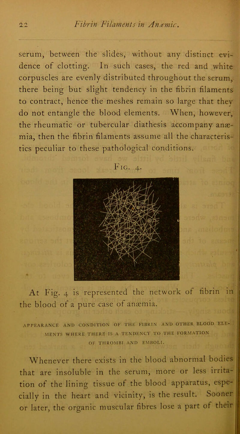 serum, between the slides, without any distinct evi- dence of clotting. In such cases, the red and white corpuscles are evenly distributed throughout the serum, there being but slight tendency in the fibrin filaments to contract, hence the meshes remain so large that thev do not entangle the blood elements. When, however, the rheumatic or tubercular diathesis accompany anae- mia, then the fibrin filaments assume all the characteris- tics peculiar to these pathological conditions. FIG. 4. At Fig. 4 is represented the network ot fibrin in the blood of a pure case of anaemia. APPEARANCE AND CONDITION OK THE FIBRIN AND OTHER BLOOD ELE- MENTS WHERE THERE IS A TENDENCY TO THE FORMATION OF THROMBI AND EMBOLI. W^henever there exists in the blood abnormal bodies that are insoluble in the serum, more or less irrita- tion of the lining tissue of the blood apparatus, espe- cially in the heart and vicinity, is the result. Sooner or later, the organic muscular fibres lose a part of their