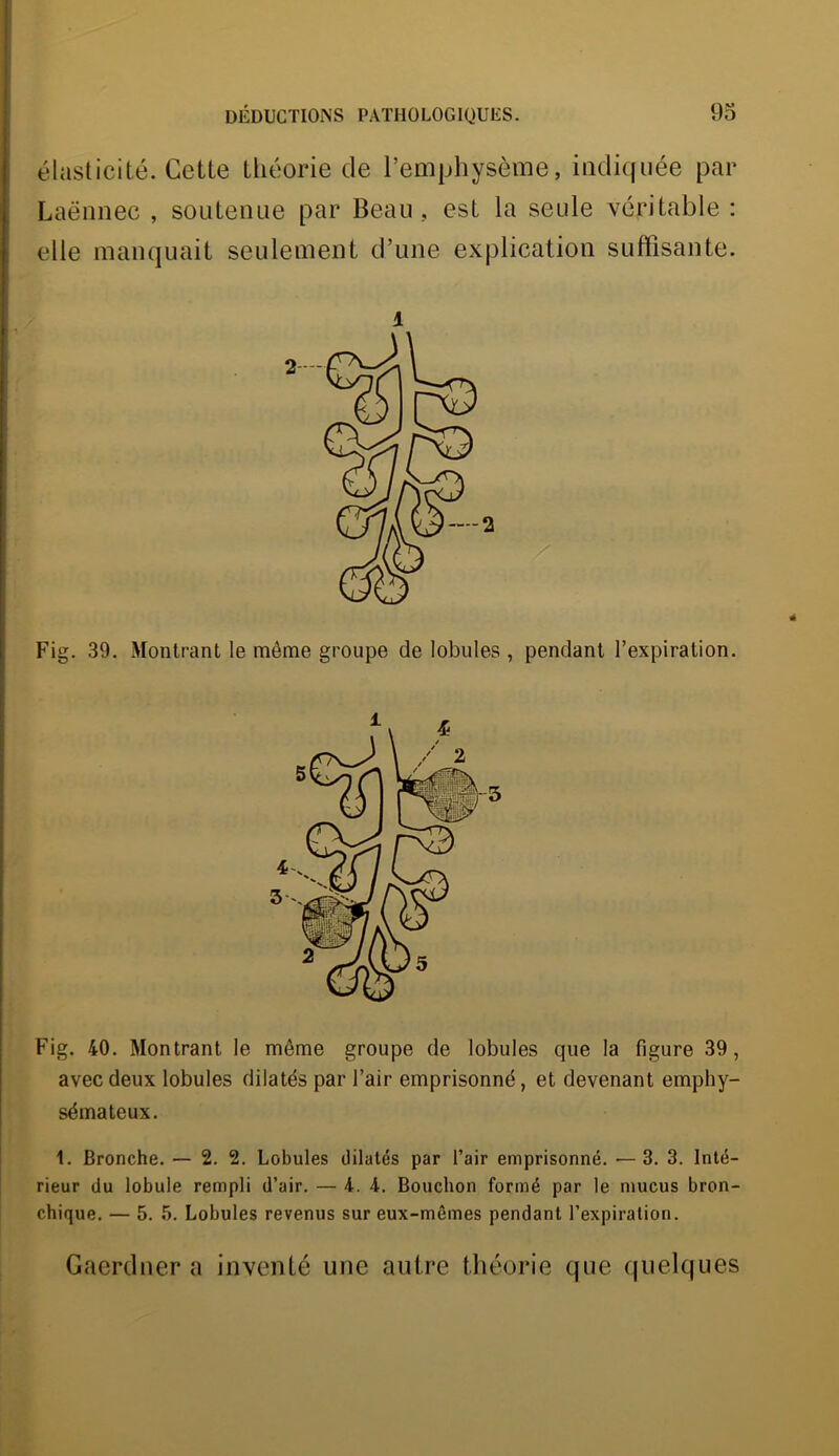 élasticité. Cette théorie de l’emphysème, indiquée par Laënnec , soutenue par Beau, est la seule véritable : elle manquait seulement d’une explication suffisante. Fig. 39. Montrant le même groupe de lobules , pendant l’expiration. Fig. 40. Montrant le môme groupe de lobules que la figure 39, avec deux lobules dilatés par l’air emprisonné, et devenant emphy- sémateux. 1. Bronche. — 2. 2. Lobules dilatés par l’air emprisonné. — 3. 3. Inté- rieur du lobule rempli d’air. — 4. 4. Bouchon formé par le mucus bron- chique. — 5. 5. Lobules revenus sur eux-mêmes pendant l’expiration. Gaerdner a inventé une autre théorie que quelques -2 5 4