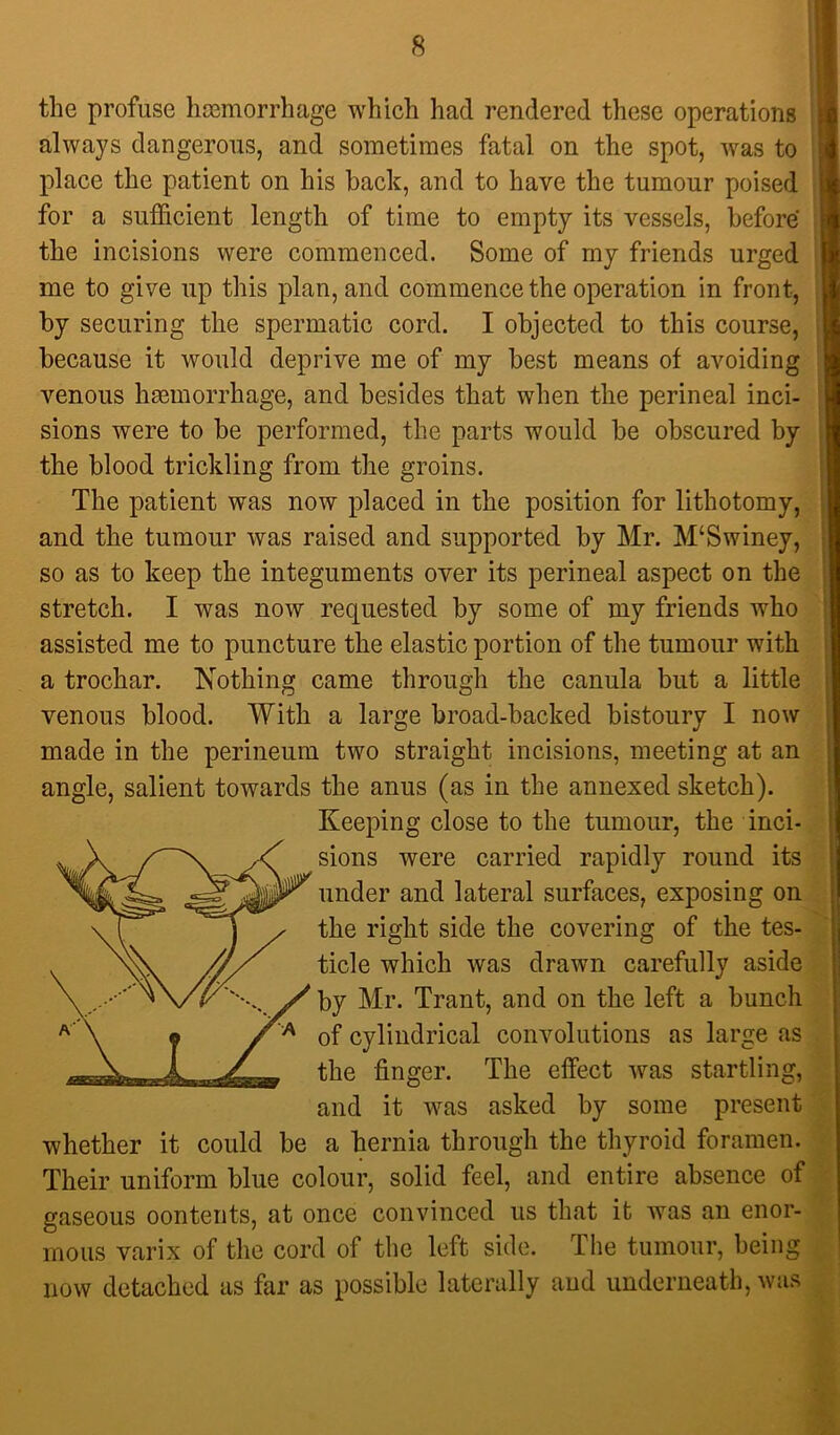 the profuse hcemorrhage which had rendered these operations always dangerous, and sometimes fatal on the spot, was to place the patient on his back, and to have the tumour poised for a sufficient length of time to empty its vessels, before' the incisions were commenced. Some of my friends urged me to give up this plan, and commence the operation in front, by securing the spermatic cord. I objected to this course, because it would deprive me of my best means of avoiding venous hemorrhage, and besides that when the perineal inci- sions were to be performed, the parts would be obscured by the blood trickling from the groins. The patient was now placed in the position for lithotomy, and the tumour was raised and supported by Mr. M‘Swiney, so as to keep the integuments over its perineal aspect on the stretch. I was now requested by some of my friends who assisted me to puncture the elastic portion of the tumour with a trochar. Nothing came through the canula but a little venous blood. With a large broad-backed bistoury I now made in the perineum two straight incisions, meeting at an angle, salient towards the anus (as in the annexed sketch). Keeping close to the tumour, the inci- ^ sions were carried rapidly round its under and lateral surfaces, exposing on the right side the covering of the tes- ticle which was drawn carefully aside by Mr. Trant, and on the left a bunch of cylindrical convolutions as large as the finger. The elfect was startling, and it was asked by some present whether it could be a hernia through the thyroid foramen. Their uniform blue colour, solid feel, and entire absence of gaseous oontents, at once convinced us that it was an enor- mous varix of the cord of the left side. The tumour, being now detached as far as possible laterally and underneath, was