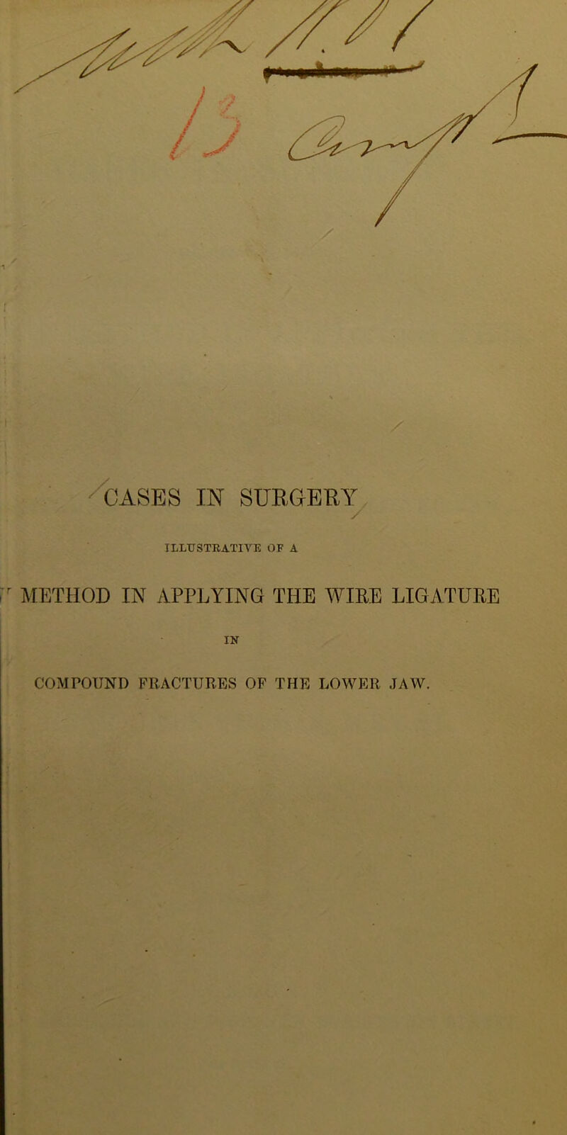 ■^ASES IN SURGERY ILLUSTRATIVE OF A r METHOD IN APPLYING THE WIRE LIGATURE IN COMPOUND FRACTURES OF THE LOWER JAW.