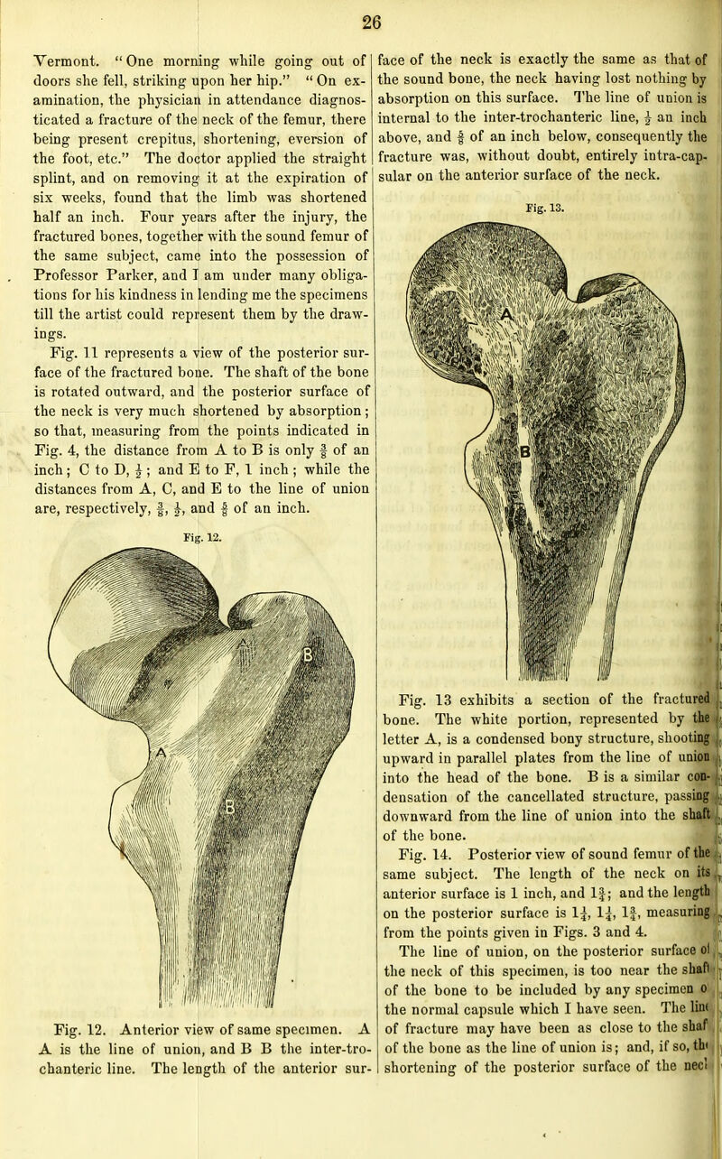 Vermont. “One morning while going out of doors she fell, striking upon her hip.” “ On ex- amination, the physician in attendance diagnos- ticated a fracture of the neck of the femur, there being present crepitus, shortening, eversion of the foot, etc.” The doctor applied the straight splint, and on removing it at the expiration of six weeks, found that the limb was shortened half an inch. Four years after the injury, the fractured bones, together with the sound femur of the same subject, came into the possession of Professor Parker, and I am under many obliga- tions for his kindness in lending me the specimens till the artist could represent them by the draw- ings. Fig. 11 represents a view of the posterior sur- face of the fractured bone. The shaft of the bone is rotated outward, and the posterior surface of the neck is very much shortened by absorption ; so that, measuring from the points indicated in Fig. 4, the distance from A to B is only | of an inch; 0 to D, £ ; and E to F, 1 inch ; while the distances from A, C, and E to the line of union are, respectively, f, and £ of an inch. Tig. 12. Fig. 12. Anterior view of same specimen. A A is the line of union, and B B the inter-tro- chanteric line. The length of the anterior sur- face of the neck is exactly the same as that of the sound bone, the neck having lost nothing by absorption on this surface. The line of union is internal to the inter-trochanteric line, £ an inch above, and £ of an inch below, consequently the fracture was, without doubt, entirely intra-cap- sular on the anterior surface of the neck. Fig. 13. 1 Fig. 13 exhibits a section of the fractured . bone. The white portion, represented by the , letter A, is a condensed bony structure, shooting ( upward in parallel plates from the line of union j, into the head of the bone. B is a similar con- ,i densation of the cancellated structure, passing .. downward from the line of union into the shaft , of the bone. |§ Fig. 14. Posterior view of sound femur of the | same subject. The length of the neck on its . anterior surface is 1 inch, and 1J; and the length on the posterior surface is 1^, 1^, If, measuring . from the points given in Figs. 3 and 4. The line of union, on the posterior surface ol .. the neck of this specimen, is too near the shafi ■■ of the bone to be included by any specimen o the normal capsule which I have seen. The line of fracture may have been as close to the shaf of the bone as the line of union is; and, if so, th< > shortening of the posterior surface of the nee! .