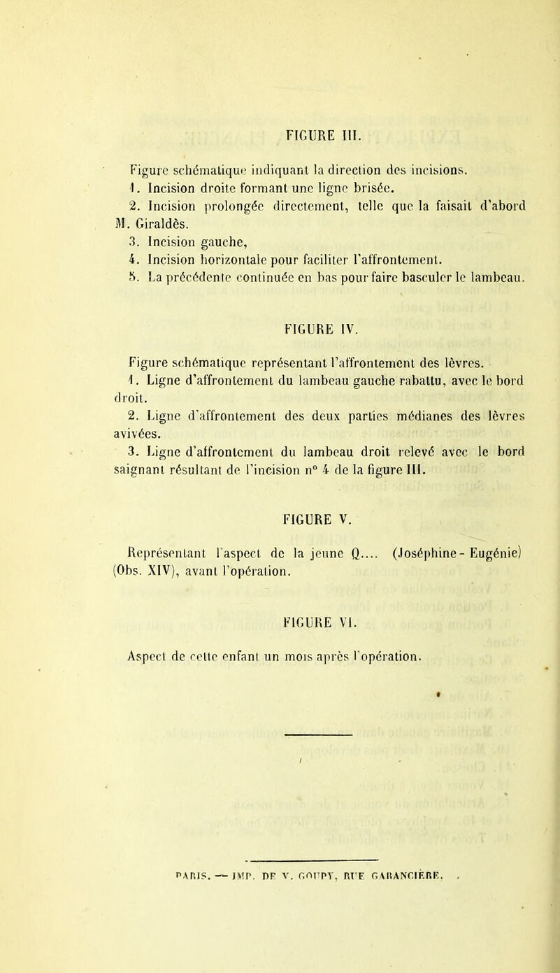 Figure schématique indiquant la direction des incisions. 1. Incision droite formant une ligne brisée. 2. Incision prolongée directement, telle que la faisait d’abord M. Giraldès. 3. Incision gauche, 4. Incision horizontale pour faciliter l'affrontement. b. Fa précédente continuée en bas pour faire basculer le lambeau. FIGURE IV. Figure schématique représentant l’affrontement des lèvres. Ligne d’affrontement du lambeau gauche rabattu, avec le bord droit. 2. Ligne d’affrontement des deux parties médianes des lèvres avivées. 3. Ligne d’affrontement du lambeau droit relevé avec le bord saignant résultant de l’incision n° 4 de la figure III. FIGURE V. Représentant l’aspect de la jeune Q.... (Joséphine- Eugénie) (Obs. XIV), avant l’opération. FIGURE VI. Aspect de celte enfant un mois après l'opération. PAMS. DF V. r.orpy, RrF GAKANCIERE. .