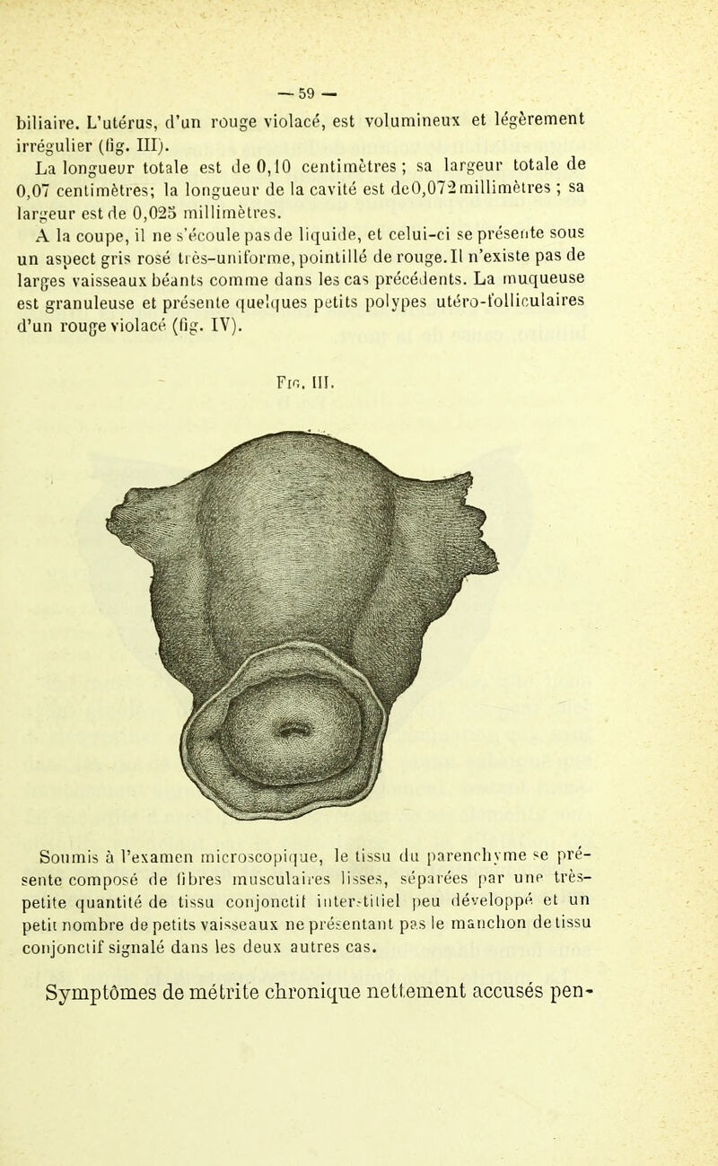 biliaire. L’utérus, d’un rouge violacé, est volumineux et légèrement irrégulier (fig. III). La longueur totale est de 0,10 centimètres; sa largeur totale de 0,07 centimètres; la longueur de la cavité est deO,072millimètres ; sa largeur est de 0,023 millimètres. A la coupe, il ne s’écoule pas de liquide, et celui-ci se présente sous un aspect gris rosé très-uniforme, pointillé de rouge. Il n’existe pas de larges vaisseaux béants comme dans les cas précédents. La muqueuse est granuleuse et présente quelques petits polypes utéro-folliculaires d’un rouge violacé (fig. IV). Fin. III. Soumis à l’examen microscopique, le tissu du parenchyme fce pré- sente composé de fibres musculaires lisses, séparées par une très- petite quantité de tissu conjonctif interstitiel peu développé et un petit nombre de petits vaisseaux ne présentant pas le manchon de tissu conjonctif signalé dans les deux autres cas. Symptômes de métrite chronique nettement accusés pen-