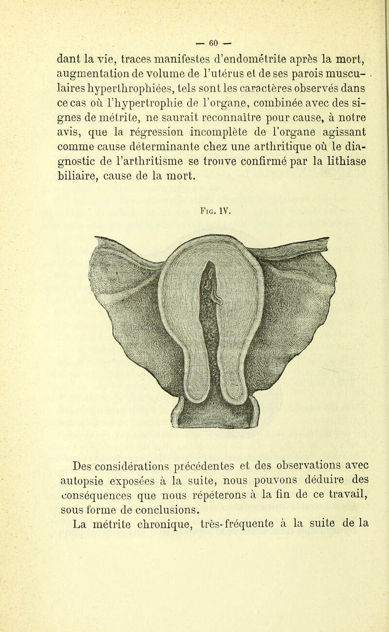 dant la vie, traces manifestes d’endométrite après la mort, augmentation de volume de l’utérus et de ses parois muscu- laires hyperthrophiées, tels sont les caractères observés dans ce cas où l’hypertrophie de l’organe, combinée avec des si- gnes de métrite, ne saurait reconnaître pour cause, à notre avis, que la régression incomplète de l’organe agissant comme cause déterminante chez une arthritique où le dia- gnostic de l’arthritisme se trouve confirmé par la lithiase biliaire, cause de la mort. Fig. IV. Des considérations précédentes et des observations avec autopsie exposées à la suite, nous pouvons déduire des conséquences que nous répéterons à la fin de ce travail, sous forme de conclusions. La métrite chronique, très-fréquente à la suite de la