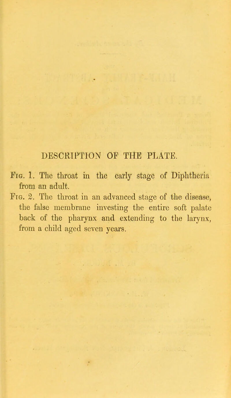 DESCRIPTION OF THE PLATE. Fig. 1. The throat in the early stage of Diphtheria from an adult. Fig. 2. The throat in an advanced stage of the disease, the false membrane investing the entire soft palate back of the pharjmx and extending to the larynx, from a child aged seven years.