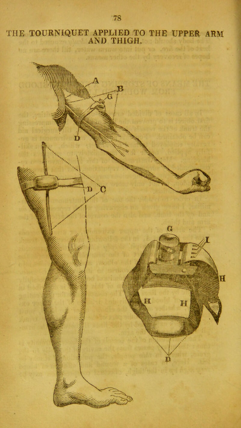 THE TOURNIQUET APPLIED TO THE UPPER ARM AND THIGH. 1