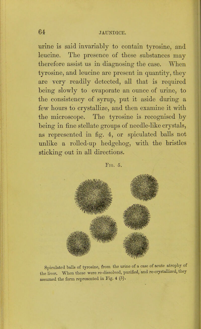 urine is said invariably to contain tyrosine, and leucine. The presence of these substances may therefore assist us in diagnosing the case. When tyrosine, and leucine are present in quantity, they are very readily detected, all that is required being slowly to evaporate an ounce of urine, to the consistency of syrup, put it aside during a few hours to crystallize, and then examine it with the microscope. The tyrosine is recognised by being in fine stellate groups of needle-like crystals, as represented in fig. 4, or spiculated balls not unlike a rolled-up hedgehog, with the bristles sticking out in all directions. Tig. 5. Spiculated balls of tyrosine, from the urme of a case of acute atrophy of the liver. When these were re-dissolved, purified, and re-crystallized, they assumed the form represented in Fig. 4 (l>).