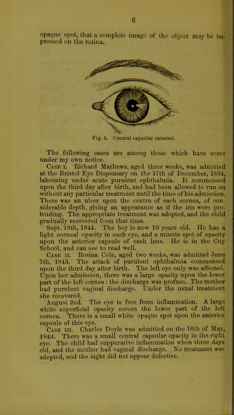 opaque spot, that a complete image of the object may be im- pressed on the retina. Fig. 4. Central capsular cataract. The following cases are among those which have come under my own notice. Case i. Richard Mathews, aged three weeks, was admitted at the Bristol Eye Dispensary on the 17th of December, 1834, labouring under acute purulent ophthalmia. It commenced upon the third day after birth, and had been allowed to run on without any particular treatment until the time of his admission. There was an ulcer upon the centre of each cornea, of con- siderable depth, giving an appearance as if the iris were pro- truding. The appropriate treatment was adopted, and the child gradually recovered from that time. Sept. 18th, 1844. The boy is now 10 years old. He has a light corneal opacity in each eye, and a minute spot of opacity upon the anterior capsule of each lens. He is in the City School, and can see to read well. Case ii. Rosina Cole, aged two weeks, was admitted June 7th, 1843. The attack of purulent ophthalmia commenced upon the third day after birth. The left eye only was affected. Upon her admission, there was a large opacity upon the lower part of the left cornea: the discharge was profuse. The mother had purulent vaginal discharge. Under the usual treatment she recovered. August 2nd. The eye is free from inflammation. A large white superficial opacity covers the lower part of the left cornea. There is a small white opaque spot upon the anterior capsule of this eye. Case m. Charles Doyle was admitted on the 16th of May, 1849. There was a small central capsular opacity in the right eye. The child had suppurative inflammation when three days old, and the mother had vaginal discharge. No treatment was adopted, and the sight did not appear defective.