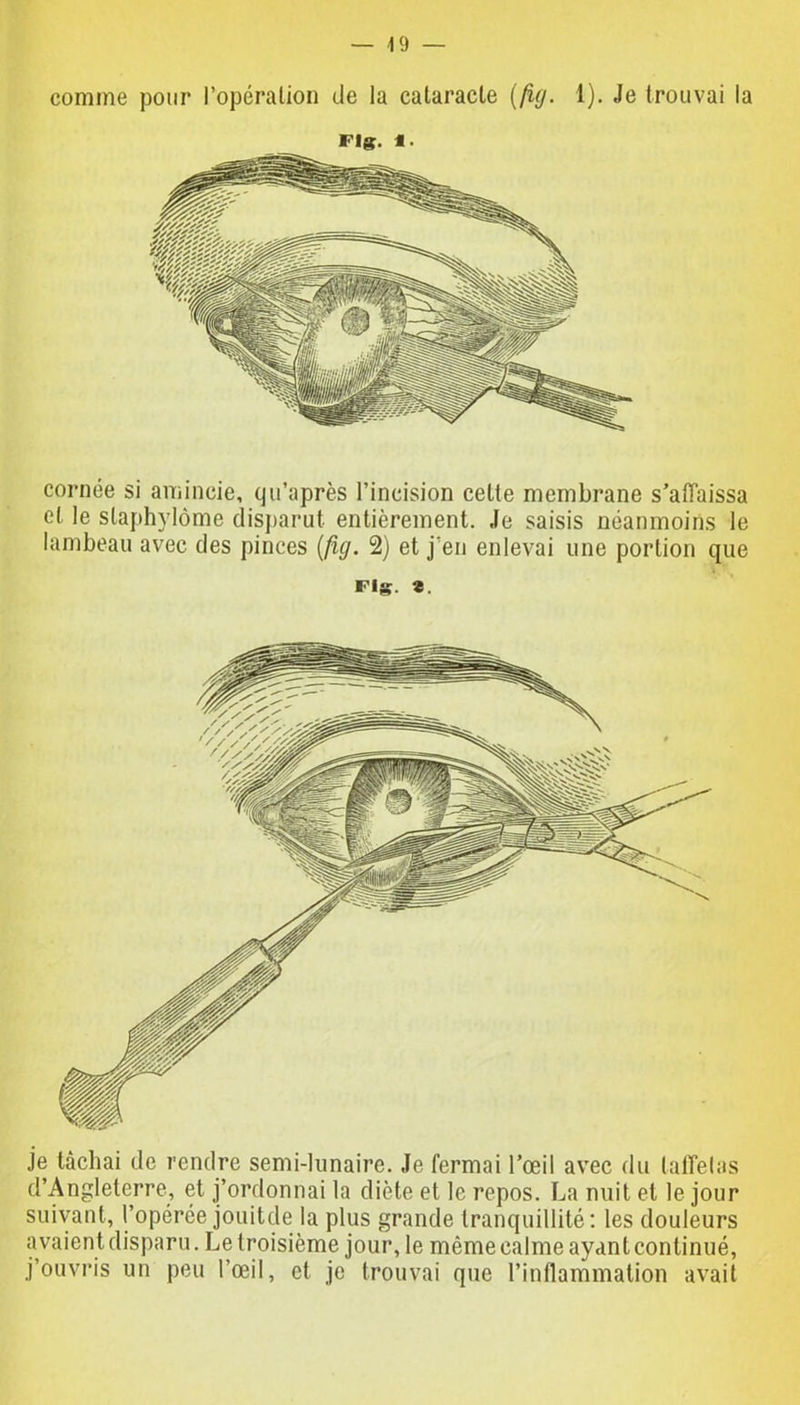 comme pour l’opération de la cataracte (fig. 1). Je trouvai la cornée si amincie, qu’après l’incision celte membrane s’affaissa et le slaphylôme disparut entièrement. Je saisis néanmoins le lambeau avec des pinces (fig. 2) et j’en enlevai une portion que ns. «. Je tâchai de rendre semi-lunaire. Je fermai l’œil avec du taffetas d’Angleterre, et j’ordonnai la diète et le repos. La nuit et le jour suivant, l’opérée jouitde la plus grande tranquillité: les douleurs avaient disparu. Le troisième jour, le même calme ayant continué, j’ouvris un peu l’œil, et je trouvai que l’inflammation avait