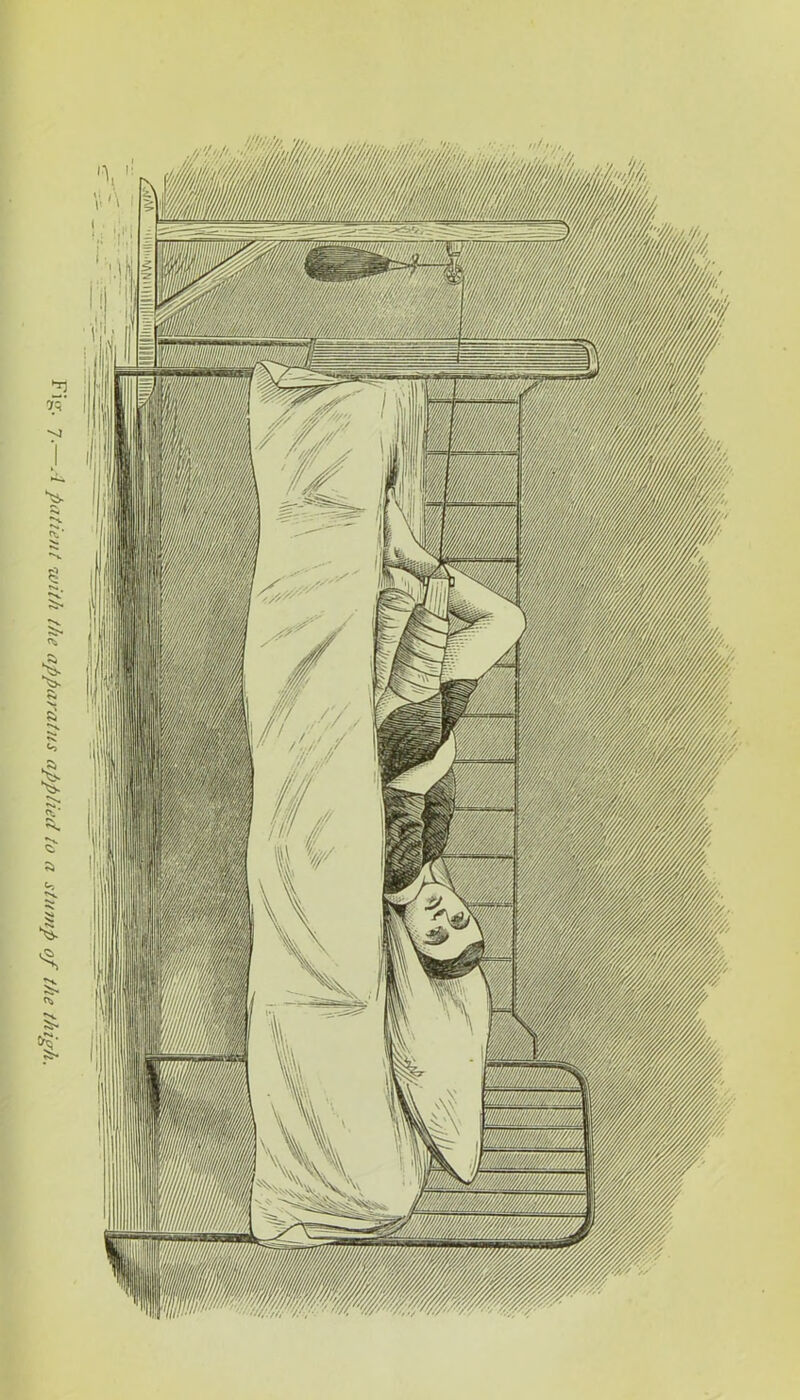 .1 patient with the apparatus applied to a stump of the thigh. Tl if Vim wi/ii ■Wiilm:. mw S/mmw//m////m. W///MW///MMWA ////////////'// / '
