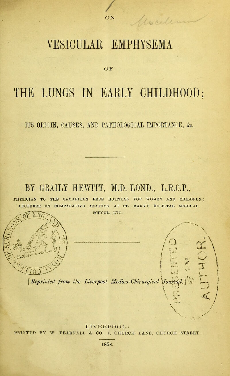 / ON VESICULAR EMPHYSEMA OF THE LUNGS IN EARLY CHILDHOOD; ITS ORIGIN, CAUSES, AND PATHOLOGICAL IMPORTANCE, &c. BY GMILY HEWITT, M.D. BOND., L.B.C.P., PHYSICIAN TO THE SAMARITAN FREE HOSPITAL FOR WOMEN AND CHILDREN LECTURER ON COMPARATIVE ANATOMY AT ST. MARY’S HOSPITAL MEDICAL SCHOOL, ETC. i '4\ /S>' /a' <IA k / / o / , ! \ cc \ :X \ ’Liii£diy i [.Reprinted from the Liverpool Medico-Ckirurgical \dou: \ r ! / / LIVERPOOL: PRINTED BY W. PEAK NALL & CO., 1, CHURCH LANE, CHURCH STREET. 1858.