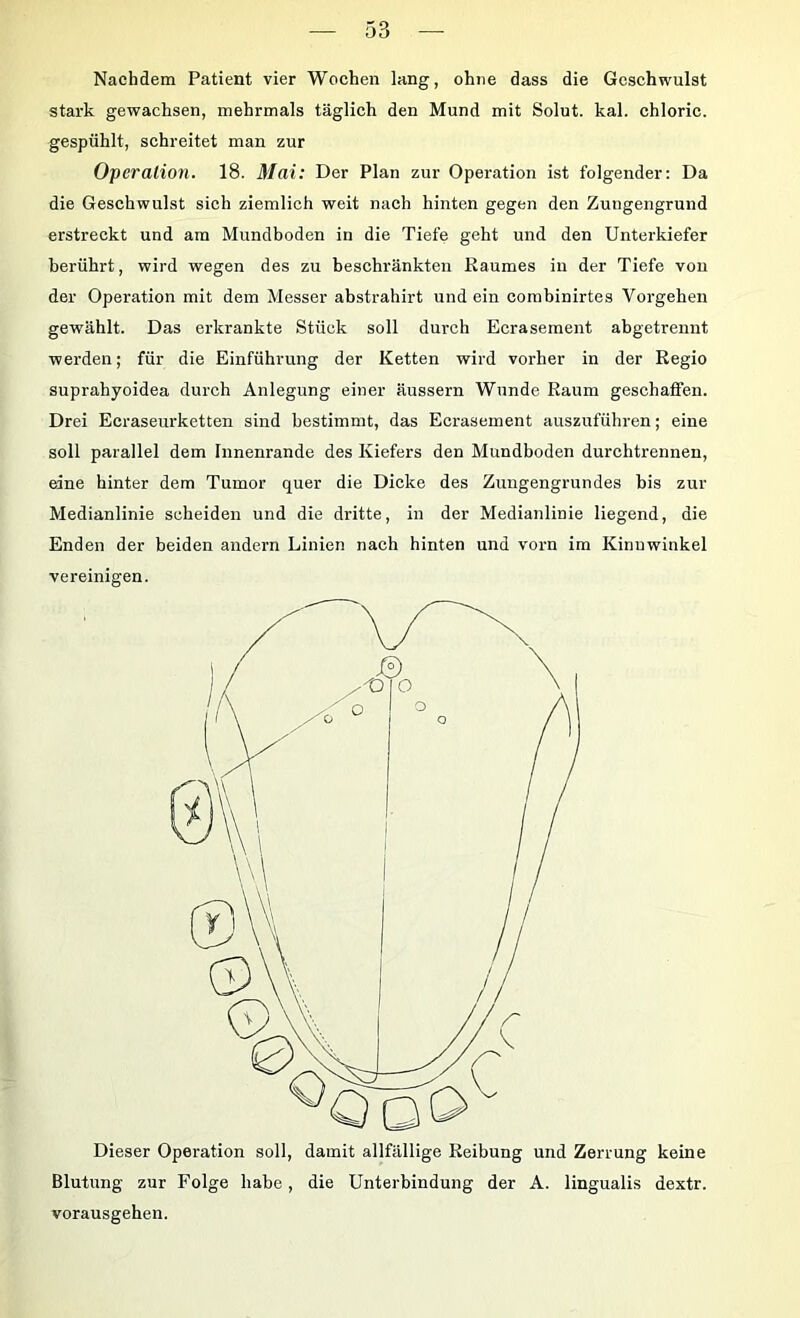 Nachdem Patient vier Wochen lang, ohne dass die Geschwulst stark gewachsen, mehrmals täglich den Mund mit Solut. kal. chloric. gespühlt, schreitet man zur Operation. 18. Mai: Der Plan zur Operation ist folgender: Da die Geschwulst sich ziemlich weit nach hinten gegen den Zungengrund erstreckt und am Mundboden in die Tiefe geht und den Unterkiefer berührt, wird wegen des zu heschränkten Raumes in der Tiefe von der Operation mit dem Messer ahstrahirt und ein combinirtes Vorgehen gewählt. Das erkrankte Stück soll durch Ecrasement abgetrennt werden; für die Einführung der Ketten wird vorher in der Regio suprahyoidea durch Anlegung einer äussern Wunde Raum geschaffen. Drei Ecraseurketten sind bestimmt, das Ecrasement auszuführen; eine soll parallel dem Innenrande des Kiefers den Mundboden durchtrennen, eine hinter dem Tumor quer die Dicke des Zuugengrundes bis zur Medianlinie scheiden und die dritte, in der Medianlinie liegend, die Enden der beiden andern Linien nach hinten und vorn im Kinuwinkel vereinigen. Dieser Operation soll, damit allfällige Reibung und Zerrung keine Blutung zur Folge habe, die Unterbindung der A. lingualis dextr. vorausgehen.