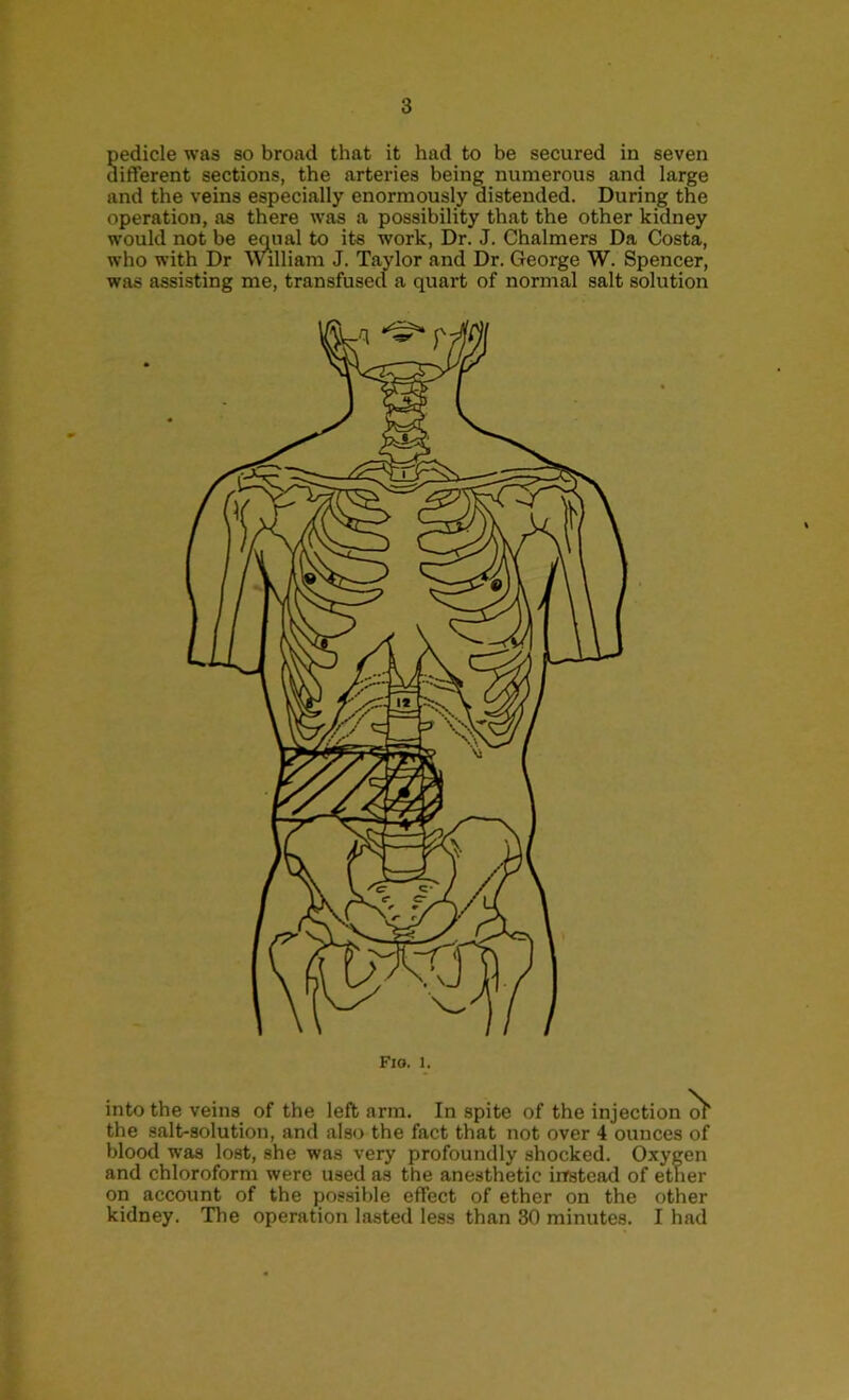 pedicle was so broad that it had to be secured in seven different sections, the arteries being numerous and large and the veins especially enormously distended. During the operation, as there was a possibility that the other kidney would not be emml to its work, Dr. J. Chalmers Da Costa, who with Dr William J. Taylor and Dr. George W. Spencer, was assisting me, transfused a quart of normal salt solution into the veins of the left arm. In spite of the injection o> the salt-solution, and also the fact that not over 4 ounces of blood was lost, she was very profoundly shocked. Oxygen and chloroform were used as the anesthetic instead of ether on account of the possible effect of ether on the other kidney. The operation lasted less than 30 minutes. I had
