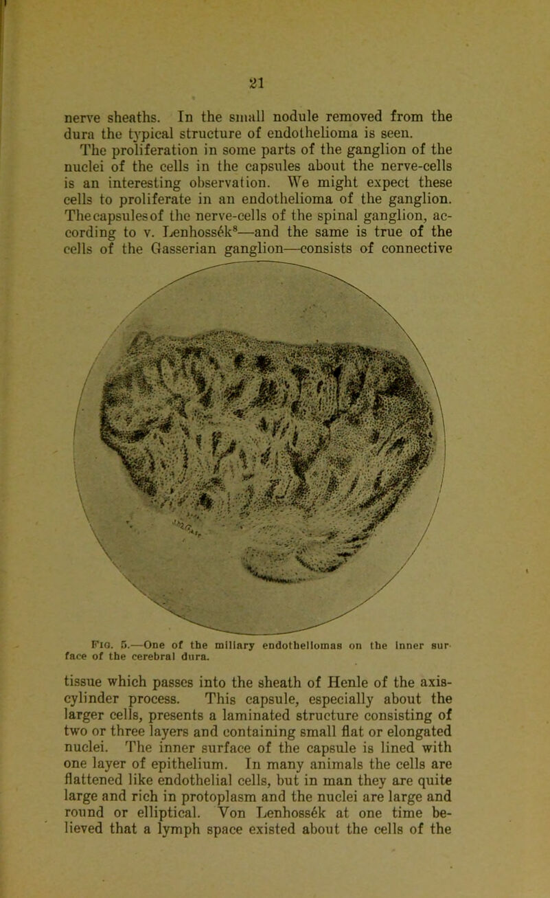 ai nerve sheaths. In the small nodule removed from the dura the typical structure of endothelioma is seen. The proliferation in some parts of the ganglion of the nuclei of the cells in the capsules about the nerve-cells is an interesting observation. We might expect these cells to proliferate in an endothelioma of the ganglion. Thecapsulesof the nerve-cells of the spinal ganglion, ac- cording to v. Lenhoss6k8—and the same is true of the cells of the Gasserian ganglion—consists of connective Fio. 5.—One of the miliary endotheliomas on the inner sur face of the cerebral dura. tissue which passes into the sheath of Henle of the axis- cylinder process. This capsule, especially about the larger cells, presents a laminated structure consisting of two or three layers and containing small flat or elongated nuclei. The inner surface of the capsule is lined with one layer of epithelium. In many animals the cells are flattened like endothelial cells, but in man they are quite large and rich in protoplasm and the nuclei are large and round or elliptical. Yon Lenhossek at one time be- lieved that a lymph space existed about the cells of the