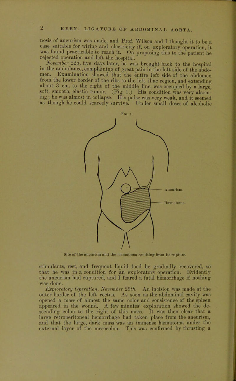 nosis of aneurism was made, and Prof. Wilson and I thought it to l)e a case suitable for wiring and electricity if, on exjiloratory operation, it was found practicable to reach it. On proposing this to the patient he rejected operation and left the hospital. November 22d, five days later, he was brought back to the hospital in the ambulance, complaining of great pain in the left side of the abdo- men. Examination showed that the entire left side of the abdomen from the lower border of the ribs to the left iliac region, and extending about 3 cm. to the right of the middle line, was occupied by a large, soft, smooth, elastic t-umor. (Fig. 1.) His condition was very alarm- ing ; he was almost in collapse. His pulse was very weak, and it seemed as though he could scarcely survive. Under small doses of alcoholic Fig. 1. Site of the aneurism and the luematoma resulting from its rupture. stimulants, rest, and frequent liquid food he gradually recovered, so that he was in a condition for an exploratory operation. Evidently the aneurism had ruptured, and I feared a fatal hemorrhage if nothing was done. Exploratory Operation, November 2%th. An incision was made at the outer border of the left rectus. As soon as the abdominal cavity was opened a mass of almost the same color and consistence of the spleen appeared in the wound. A few minutes’ exploration showed the de- scending colon to the right of this mass. It was then clear that a large retroperitoneal hemorrhage had taken place from the aneurism, and that the large, dark mass was an immense hsematoma under the external layer of the mesocolon. This was confirmed by thrusting a