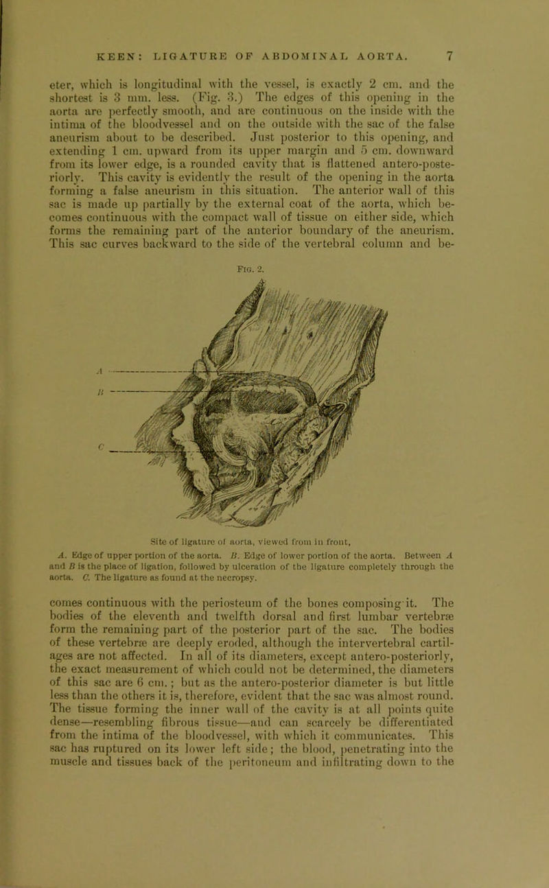 eter, which is longitudinal with the vessel, is exactly 2 cm. and the shortest is 3 mm. less. (Fig. 3.) The edges of this opening in the aorta are perfectly smooth, and are continuous on the inside with the intima of the bloodvessel and on the outside with the sac of the false aneurism about to be described. Just posterior to this opening, and extending 1 cm. upward from its upper margin and 5 cm. downward from its lower edge, is a rounded cavity that is flattened antero-poste- riorly. This cavity is evidently the result of the opening in the aorta forming a false aneurism in this situation. The anterior wall of this sac is made uj) |)artially by the external coat of the aorta, which be- comes continuous with the compact wall of tissue on either side, which forms the remaining part of the anterior boundary of the aneurism. This sac curves backward to the side of the vertebral column and be- Fig. 2. Site of ligature ol aorta, viewed from iii front. A. Edge of upper portion of the aorta. IS. Edge of lower portion of the aorta. Between A and B is the place of ligation, followed by ulceration of the ligature completely through the aorta. C. The ligature as found at the necropsy. comes continuous with the periosteum of the bones composing'it. The bodies of the eleventh and twelfth dorsal and first lumbar vertebrse form the remaining part of the posterior part of the sac. The bodies of these vertebrae are deeply eroded, although the intervertebral cartil- ages are not affected. In all of its diameters, except antero-posteriorly, the exact measurement of which could not be determined, the diameters of this sac are 6 cm.; but as the antero-posterior diameter is but little less than the others it is, therefore, evident that the sac was almost round. The tis.sue forming the inner wall of the cavity is at all points quite dense—resembling fibrous ti.«sue—and can scarcely be differentiated from the intima of the bloodve.ssel, with which it communicates. This .sac has ruptured on its lower left side; the blood, penetrating into the muscle and tissues back of the peritoneum and infiltrating down to the