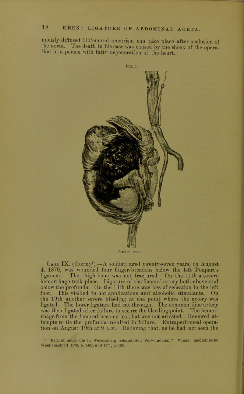 mously diffused iliofemoral aneurism can take place after occlusion of the aorta. The death in his case was caused by the shock of the opera- tion in a person with fatty degeneration of the heart. Fig. 7. Stokes’ case. Case IX. (Czerny^).—A soldier, aged twenty-seven years, on August 4, 1870, was wounded four finger-breadths below the left Poupart’s ligament. The thigh bone was not fractured. On the 11th a severe hemorrhage took place. Ligature of the femoral artery both above and below the profunda. On the 13th there was loss of sensation in the left foot. This yielded to hot applications and alcoholic stimulants. On the 19th another severe bleeding at the point where the artery was ligated. The lower ligature had cut through. The common iliac artery was then ligated after failure to secure the bleeding-point. The hemor- rhage from the femoral became less, but was not arrested. Renewed at- tempts to tie the profunda resulted in failure. Extraperitoueal opera- tion on August 19th at 9 a.m. Believing that, as he had not seen the 1 “ Berlcht ueber die in Weisseiiberg bebandeiten Verwimdeten.” Wiener medlciuische Wochenschrift, 1870, p. 1402, and 1871, p. 103.