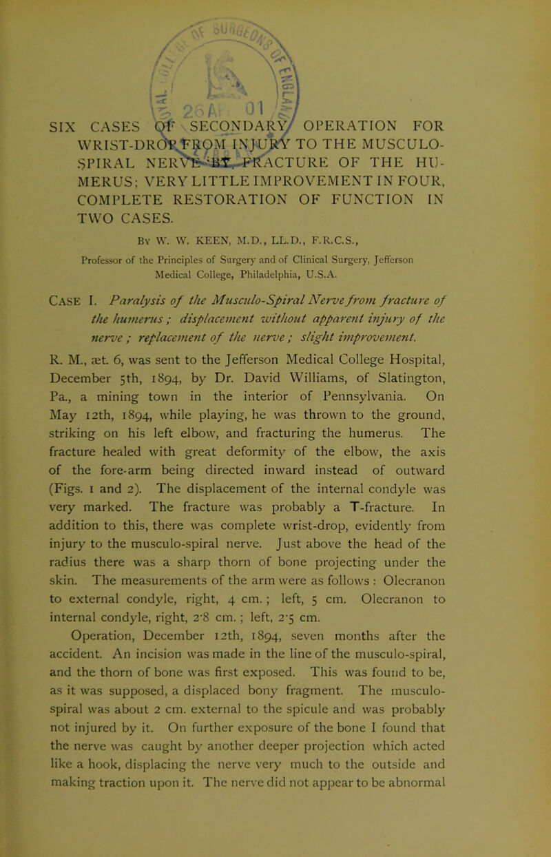 CSX /■ SIX CASES Of V SECONDARY/ OPERATION FOR WRIST-DRO^^LOM INJ*j)tY TO THE MUSCULO- SPIRAL NEIO^;-FRACTURE OF THE HU- MERUS; VERY LITTLE IMPROVEMENT IN FOUR, COMPLETE RESTORATION OF FUNCTION IN TWO CASES. By W. W. KEEN, M.D., LL.D., F.R.C.S., Professor of the Principles of Surgery and of Clinical Surgery, Jefferson Medical College, Philadelphia, U.S.A. CASE I. Paralysis of the Musculo-Spiral Nerve from fracture of the humerus ; displacement without apparent injury of the nerve ; replacement of the nerve ; slight improvement. R. M., aet. 6, was sent to the Jefferson Medical College Hospital, December 5th, 1894, by Dr. David Williams, of Slatington, Pa., a mining town in the interior of Pennsylvania. On May 12th, 1894, while playing, he was thrown to the ground, striking on his left elbow, and fracturing the humerus. The fracture healed with great deformity of the elbow, the axis of the fore-arm being directed inward instead of outward (Figs. 1 and 2). The displacement of the internal condyle was very marked. The fracture was probably a T-fracture. In addition to this, there was complete wrist-drop, evidently from injury to the musculo-spiral nerve. Just above the head of the radius there was a sharp thorn of bone projecting under the skin. The measurements of the arm were as follows : Olecranon to external condyle, right, 4 cm. ; left, 5 cm. Olecranon to internal condyle, right, 2‘8 cm.; left, 2’5 cm. Operation, December 12th, 1894, seven months after the accident. An incision was made in the line of the musculo-spiral, and the thorn of bone was first exposed. This was found to be, as it was supposed, a displaced bony fragment. The musculo- spiral was about 2 cm. external to the spicule and was probably not injured by it. On further exposure of the bone I found that the nerve was caught by another deeper projection which acted like a hook, displacing the nerve very much to the outside and making traction upon it. The nerve did not appear to be abnormal