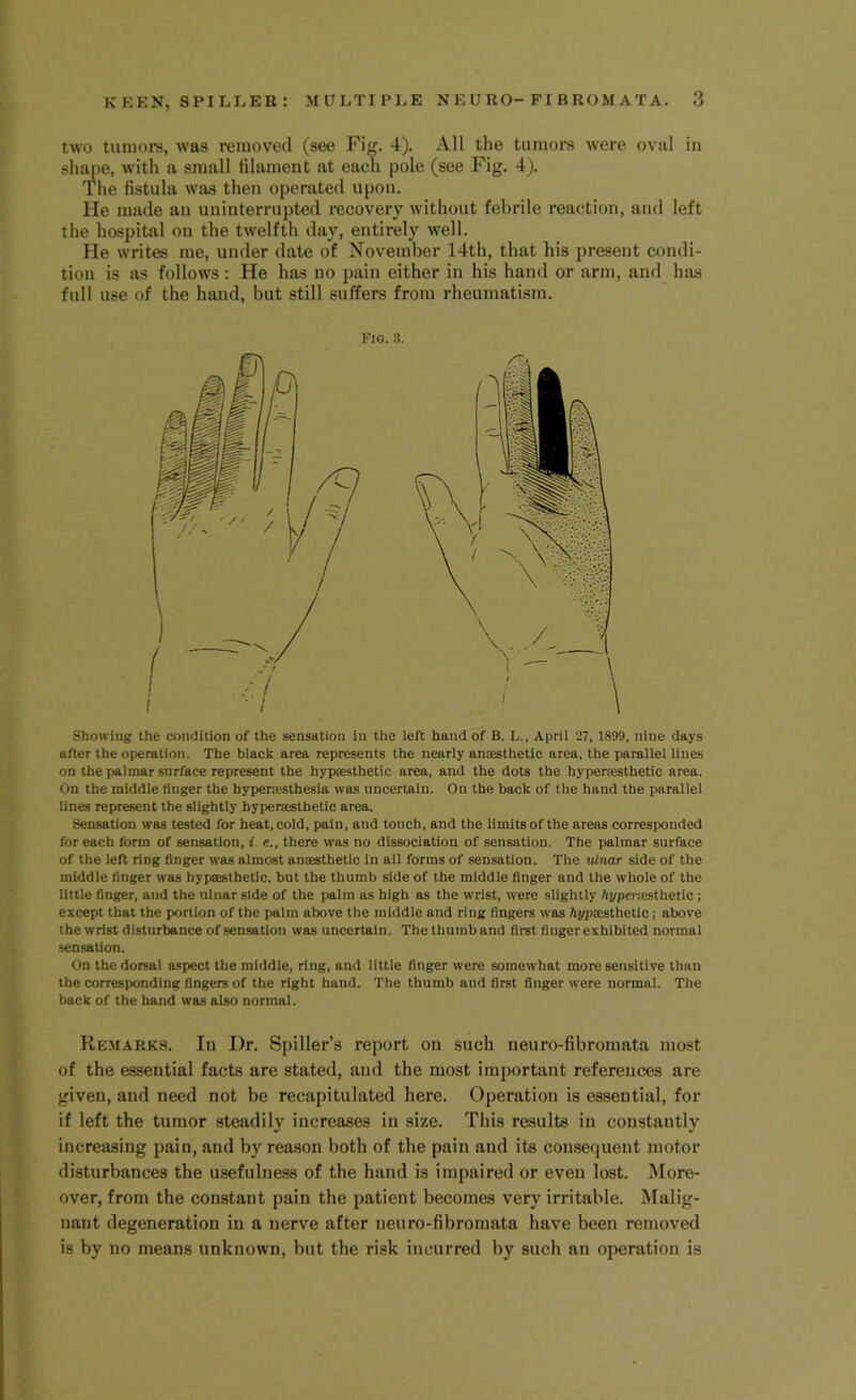 two tumors, was removed (see Fig. 4). All the tumors were oval in shape, with a small filament at each pole (see Fig. 4). The fistula was then operated upon. He made an uninterrupted recovery without febrile reaction, and left the hospital on the twelfth day, entirely well. He writes me, under date of November 14th, that his present condi- tion is as follows: He has no pain either in his hand or arm, and has full use of the hand, but still suffers from rheumatism. Fig. 3. Showing the condition of the sensation in the left hand of B. L., April 27, 1899, nine days after the operation. The black area represents the nearly antesthetic area, the parallel lines on the palmar surface represent the hypaesthetic area, and the dots the hypersesthetic area. On the middle finger the bypenesthesia was uncertain. On the back of the hand the parallel lines represent the slightly byperastbetic area. Sensation was tested for heat, cold, pain, and touch, and the limits of the areas corresponded for each form of sensation, i e., there was no dissociation of sensation. The palmar surface of the left ring finger was almost anaesthetic in all forms of sensation. The ulnar side of the middle finger was hypaesthetic, but the thumb side of the middle finger and the whole of the little finger, and the ulnar side of the palm as high as the wrist, were slightly Apperaesthetic ; except that the portion of the palm above the middle and ring fingers was Appaesthetic ; above the wrist disturbance of sensation was uncertain. Thethumband first finger exhibited normal sensation. On the dorsal aspect the middle, ring, and little finger were somewhat more sensitive than the corresponding fingers of the right hand. The thumb and first finger were normal. The back of the hand was also normal. Remarks. In Dr. Spiller’s report on such neuro-fibromata most of the essential facts are stated, and the most important references are given, and need not be recapitulated here. Operation is essential, for if left the tumor steadily increases in size. This results in constantly increasing pain, and by reason both of the pain and its consequent motor disturbances the usefulness of the hand is impaired or even lost. More- over, from the constant pain the patient becomes very irritable. Malig- nant degeneration in a nerve after neuro-fibromata have been removed is by no means unknown, but the risk incurred by such an operation is