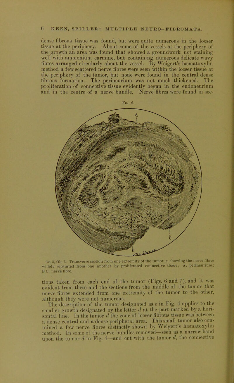 dense fibrous tissue was found, but were quite numerous in the looser tissue at the periphery. About some of the vessels at the periphery of the growth an area was found that showed a groundwork not staining well with ammonium carmine, but containing numerous delicate wavy fibres arranged circularly about the vessel. By Weigert’s haematoxyliu method a few scattered nerve fibres were seen within the looser tissue at the periphery of the tumor, but none were found in the central dense fibrous formation. The perineurium was not much thickened. The proliferation of connective tissue evidently began in the endoneurium and in the centre of a nerve bundle. Nerve fibres were found in sec- Fig. o. Oc. 3, Ob. 3. Transverse section from one extremity of the tumor, c, showing the nerve fibres widely separated from one another by proliferated connective tissue; A, perineurium; B C. nerve fibre. tious taken from each end of the tumor (Figs. 6 and 7), and it was evident from these and (be sections from the middle of the tumor that nerve fibres extended from one extremity of the tumor to the other, although they were not numerous. The description of the tumor designated as c in Fig. 4 applies to the smaller growth designated by the letter d at the part marked by a hori- zontal line. In the tumor d the zone of looser fibrous tissue was between a dense central and a dense peripheral area. This small tumor also con- tained a few nerve fibres distinctly shown by Weigert’s hsematoxylin method. In some of the nerve bundles removed—seen as a narrow band upon the tumor d in Fig. 4—and cut with the tumor d, the connective