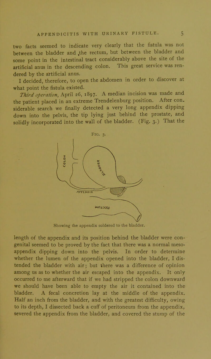 two facts seemed to indicate very clearly that the fistula was not between the bladder and ,the rectum, but between the bladder and some point in the intestinal tract considerably above the site of the artificial anus in the descending colon. This great service was ren- dered by the artificial anus. I decided, therefore, to open the abdomen in order to discover at what point the fistula existed. Third operation, April 26, 1897. A median incision was made and the patient placed in an extreme Trendelenburg position. After con. siderable search we finally detected a very long appendix dipping down into the pelvis, the tip lying just behind the prostate, and solidly incorporated into the wall of the bladder. (Fig. 3.) That the Fig. 3. Showing the appendix soldered to the bladder. length of the appendix and its position behind the bladder were con- genital seemed to be proved by the fact that there was a normal meso- appendix dipping down into the pelvis. In order to determine whether the lumen of the appendix opened into the bladder, I dis- tended the bladder with air; but there was a difference of opinion among us as to whether the air escaped into the appendix. It only occurred to me afterward that if we had stripped the colon downward we should have been able to empty the air it contained into the bladder. A fecal concretion lay at the middle of the appendix. Half an inch from the bladder, and with the greatest difficulty, owing to its depth, I dissected back a cuff of peritoneum from the appendix, severed the appendix from the bladder, and covered the stump of the