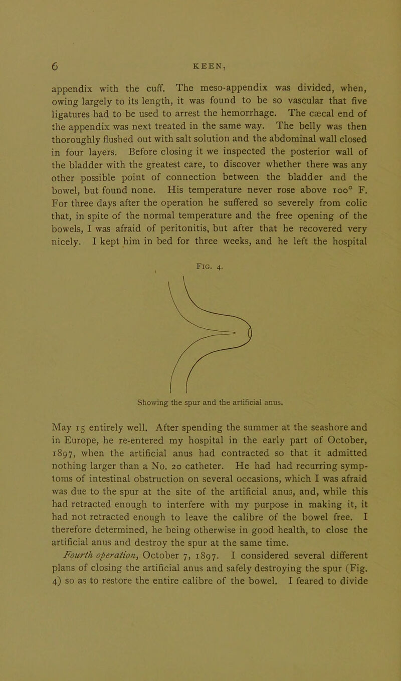 appendix with the cuff. The meso-appendix was divided, when, owing largely to its length, it was found to be so vascular that five ligatures had to be used to arrest the hemorrhage. The csecal end of the appendix was next treated in the same way. The belly was then thoroughly flushed out with salt solution and the abdominal wall closed in four layers. Before closing it we inspected the posterior wall of the bladder with the greatest care, to discover whether there was any other possible point of connection between the bladder and the bowel, but found none. His temperature never rose above ioo° F. For three days after the operation he suffered so severely from colic that, in spite of the normal temperature and the free opening of the bowels, I was afraid of peritonitis, but after that he recovered very nicely. I kept him in bed for three weeks, and he left the hospital Fig. 4. Showing the spur and the artificial anus. May 15 entirely well. After spending the summer at the seashore and in Europe, he re-entered my hospital in the early part of October, 1897, when the artificial anus had contracted so that it admitted nothing larger than a No. 20 catheter. He had had recurring symp- toms of intestinal obstruction on several occasions, which I was afraid was due to the spur at the site of the artificial anus, and, while this had retracted enough to interfere with my purpose in making it, it had not retracted enough to leave the calibre of the bowel free. I therefore determined, he being otherwise in good health, to close the artificial anus and destroy the spur at the same time. Fourth operation, October 7, 1897. I considered several different plans of closing the artificial anus and safely destroying the spur (Fig. 4) so as to restore the entire calibre of the bowel. I feared to divide