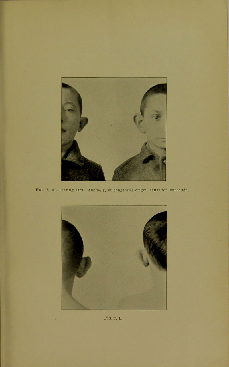 Fig. G. a.—Flaring ears. Anomaly, of congenital origin, causation uncertain. Fig. P, b.