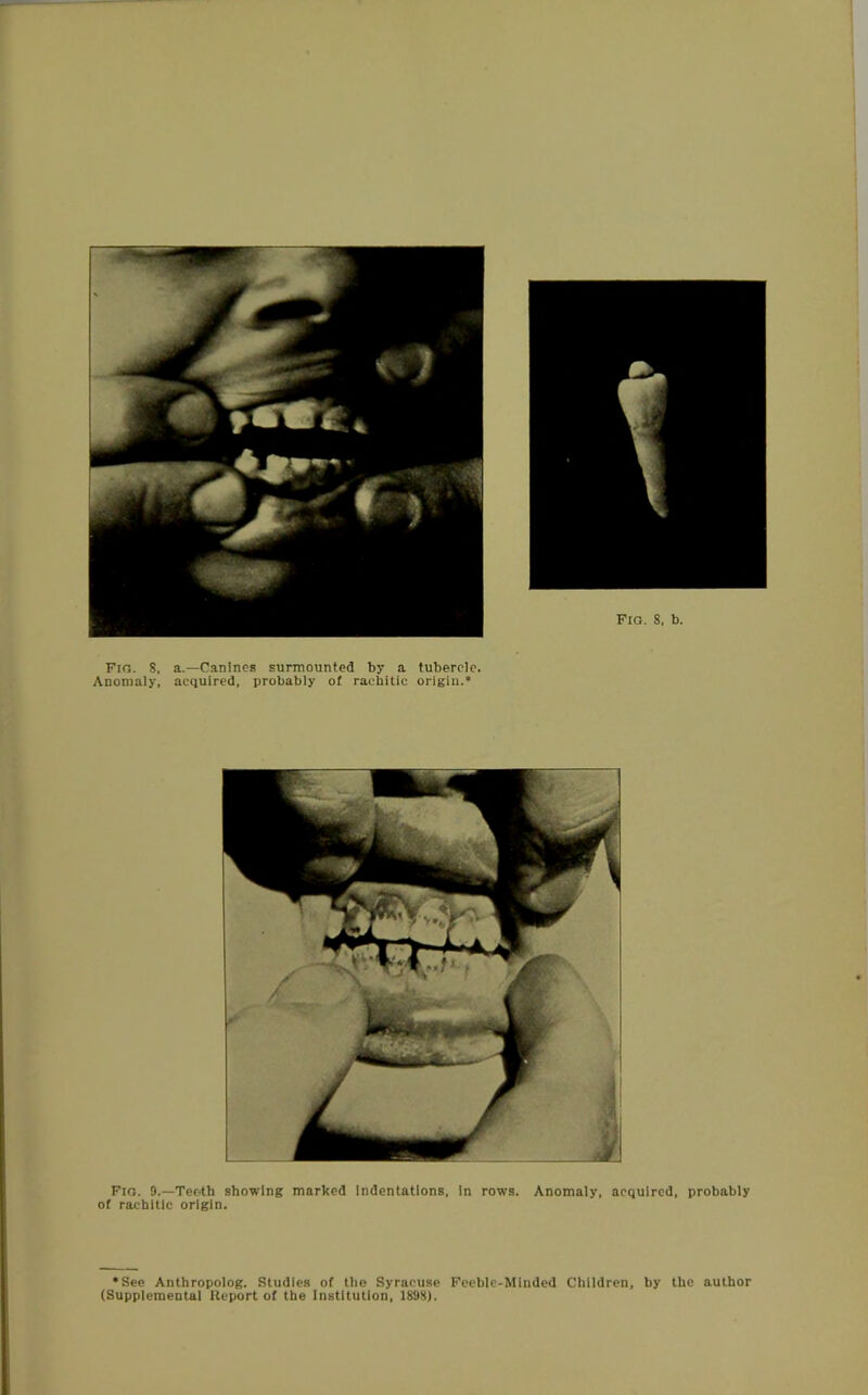 Anomaly, acquired, probably of rachitic origin.* Fig. 9.—Teeth showing marked indentations, in rows. Anomaly, acquired, probably of rachitic origin. *See Anthropolog. Studies of the Syracuse Feeble-Minded Children, by the author (Supplemental Report of the Institution, 1898).