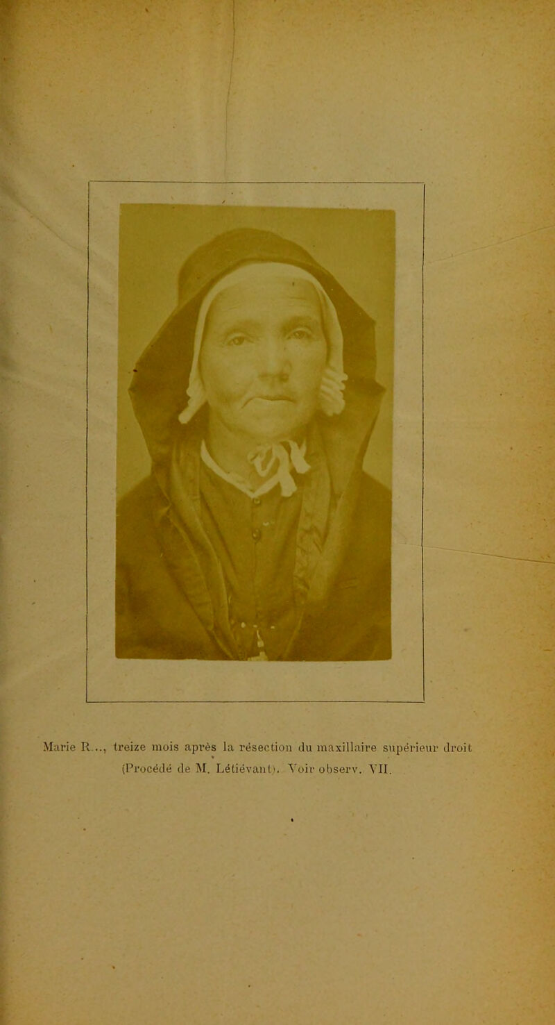 Marie R .., treize mois après la résection du maxillaire supérieur droit (Procédé de M. Létiévant). Voir observ. VII.