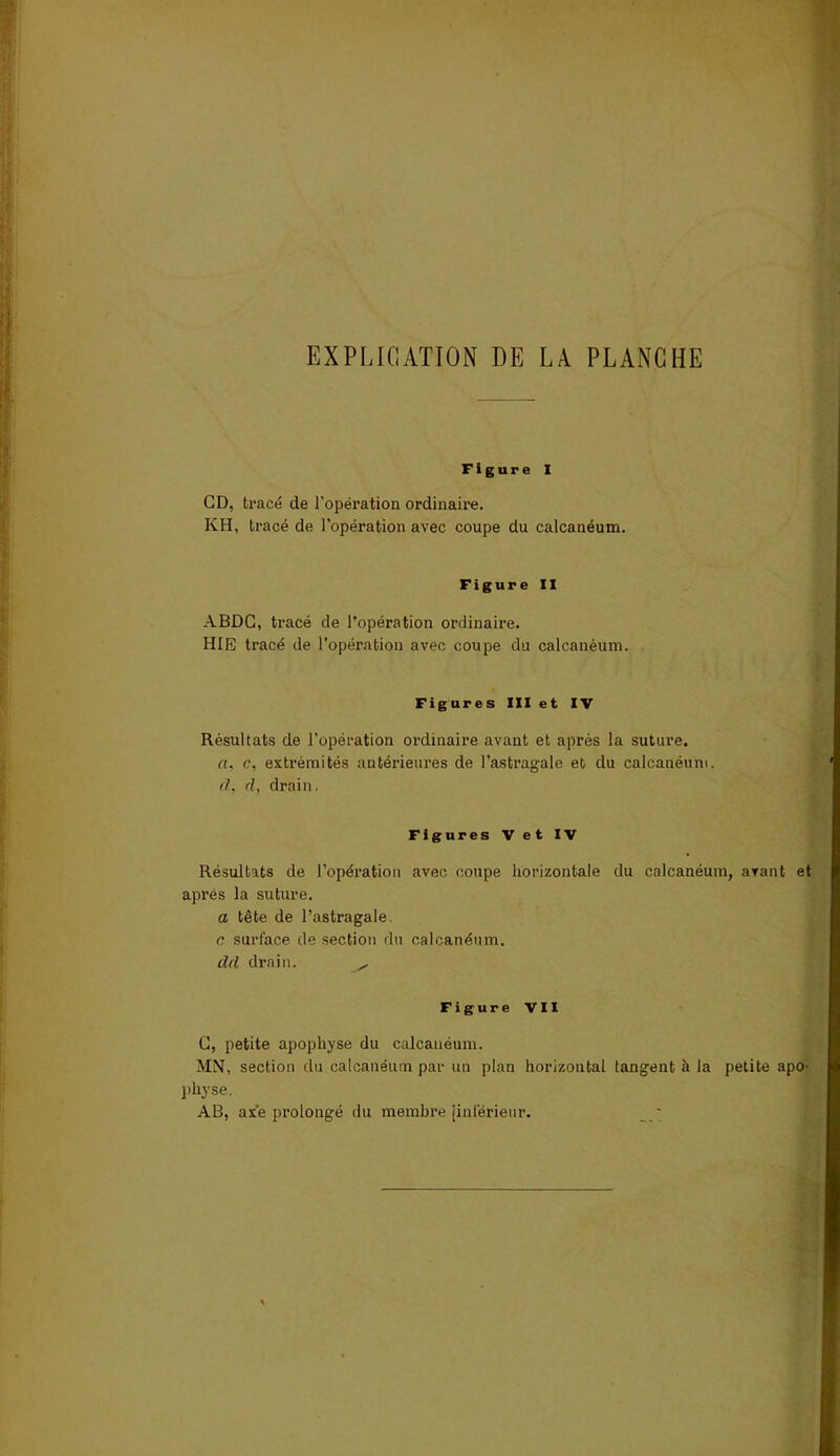 Figure I CD, tracé de l’opération ordinaire. KH, tracé de l’opération avec coupe du calcanéum. Figure II ABDC, tracé de l’opération ordinaire. HIE tracé de l’opération avec coupe du calcanéum. Figures III et IV Résultats de l’opération ordinaire avant et après la suture. a, c, extrémités antérieures de l’astragale et du calcanéum. d. cl, drain. Figures V et IV Résultats de l’opération avec coupe horizontale du calcanéum, avant et après la suture. a tête de l’astragale c surface de section du calcanéum. dcl drain. ^ Figure VII G, petite apophyse du calcanéum. MN, section du calcanéum par un plan horizontal tangent à la petite apo- physe. AB, axe prolongé du membre [inférieur.