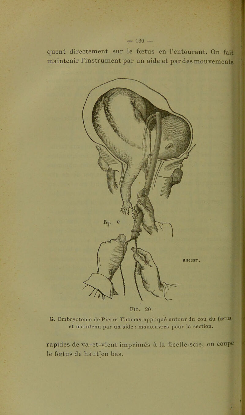 quent directement sur le fœtus en l’entourant. On fait maintenir l’instrument par un aide et par des mouvements Fig. 20. G. Embryotome de Pierre Thomas appliqué autour du cou du foetus et maintenu par un aide : manœuvres pour la section. rapides de va-et-vient imprimés à la ficelle-scie, on coupe le fœtus de haut'en bas.