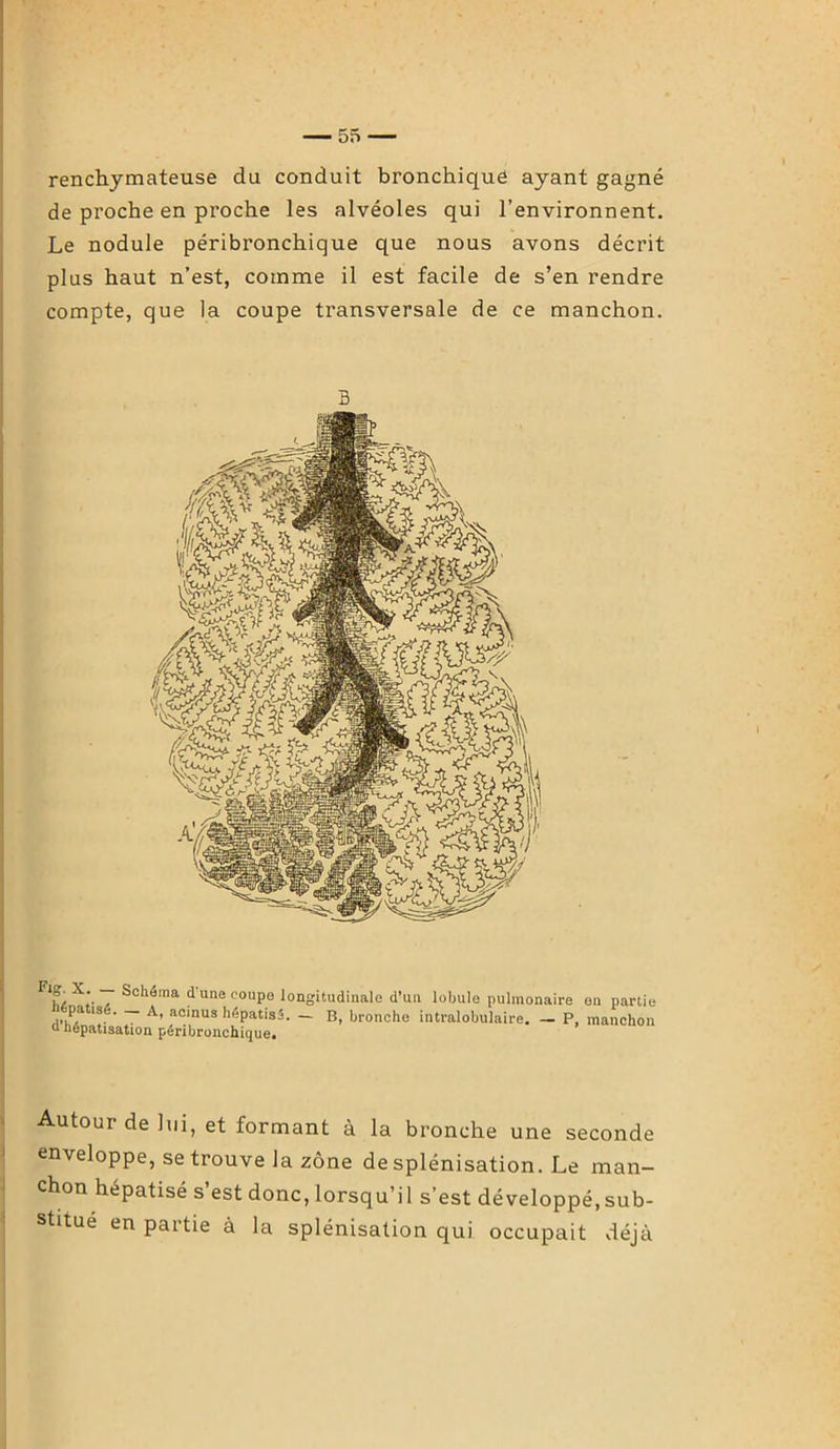 renchymateuse du conduit bronchique ayant gagné de proche en proche les alvéoles qui l’environnent. Le nodule péribronchique que nous avons décrit plus haut n’est, comme il est facile de s’en rendre compte, que la coupe transversale de ce manchon. 3 Fl?, X*'- / Sclléma d une C0UP° longitudinale d’un lobule pulmonaire en partie ,,,pa l®. ‘ — A’ acinus hépatisé. — B, bronche intralobulaire. — P, manchon ü hépatisation péribronchique. Autour de lui, et formant à la bronche une seconde enveloppe, se trouve la zone de splénisation. Le man- chon hépatisé s est donc, lorsqu’i 1 s’est développé, sub- stitué en partie à la splénisation qui occupait déjà