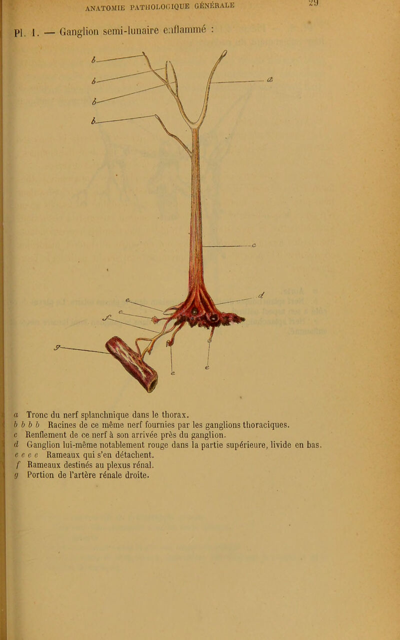 PI | — Ganglion semi-lunaire enflammé : a Tronc du nerf splanchnique dans le thorax. b b b b Racines de ce même nerf fournies par les ganglions thoraciques, c Renflement de ce nerf à son arrivée près du ganglion. d Ganglion lui-même notablement rouge dans la partie supérieure, livide en bas. e e e e Rameaux qui s’en détachent. f Rameaux destinés au plexus rénal. g Portion de l’artère rénale droite.