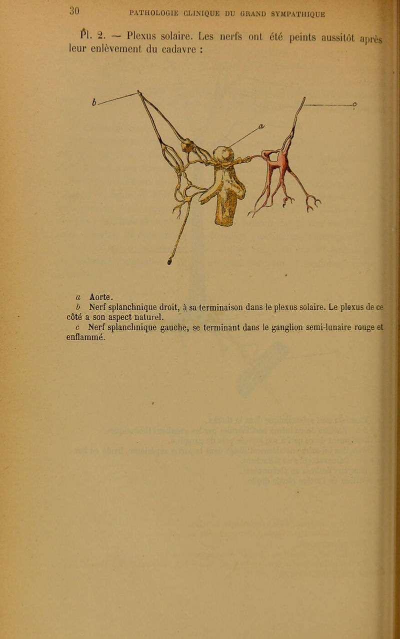 Pl- -• — Plexus solaire. Les nerfs oui été peints aussitôt après leur enlèvement du cadavre : a Aorte. b Nerf splanchnique droit, à sa terminaison dans le plexus solaire. Le plexus de ce côté a son aspect naturel. c Nerf splanchnique gauche, se terminant dans le ganglion semi-lunaire rouge et enflammé.