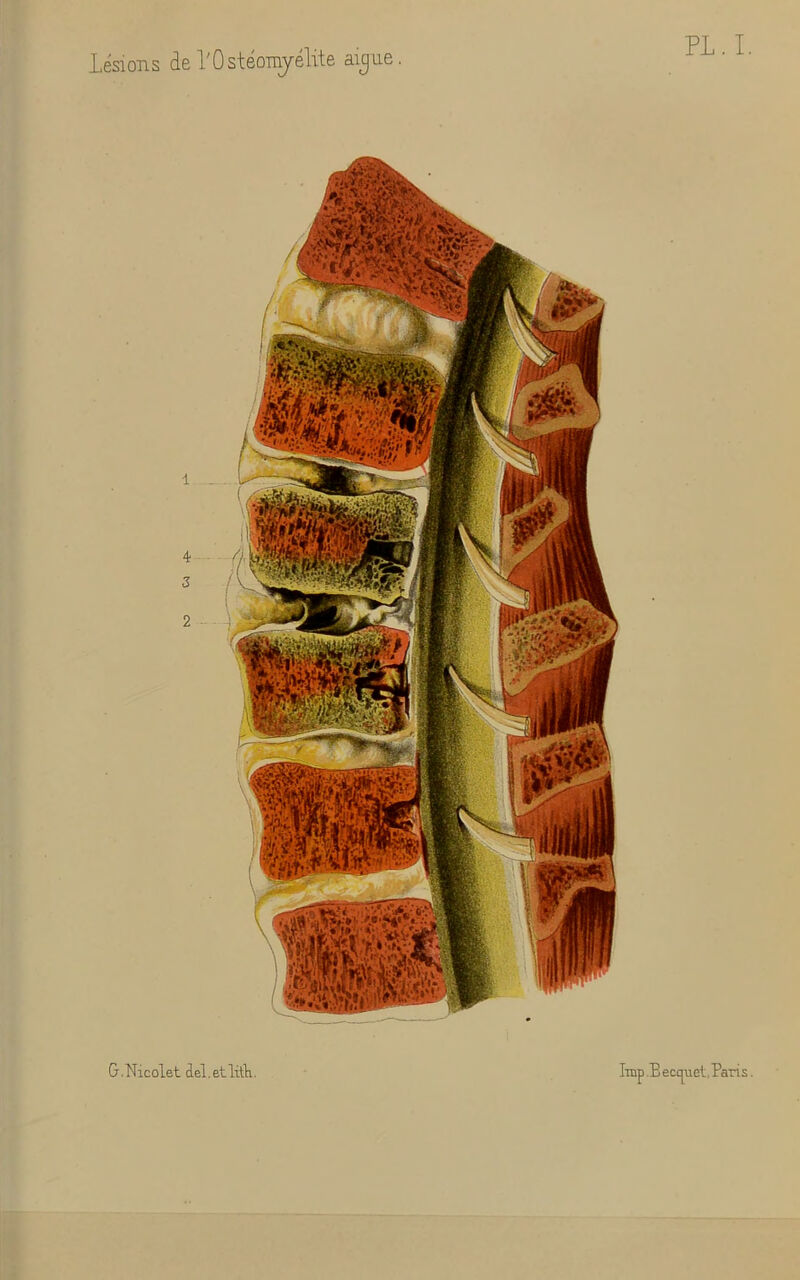 Lésions de l'Ostéomyélite aigue. PL . I. G .Nicolet del. etlitli. lmp .B eccpet, Paris.