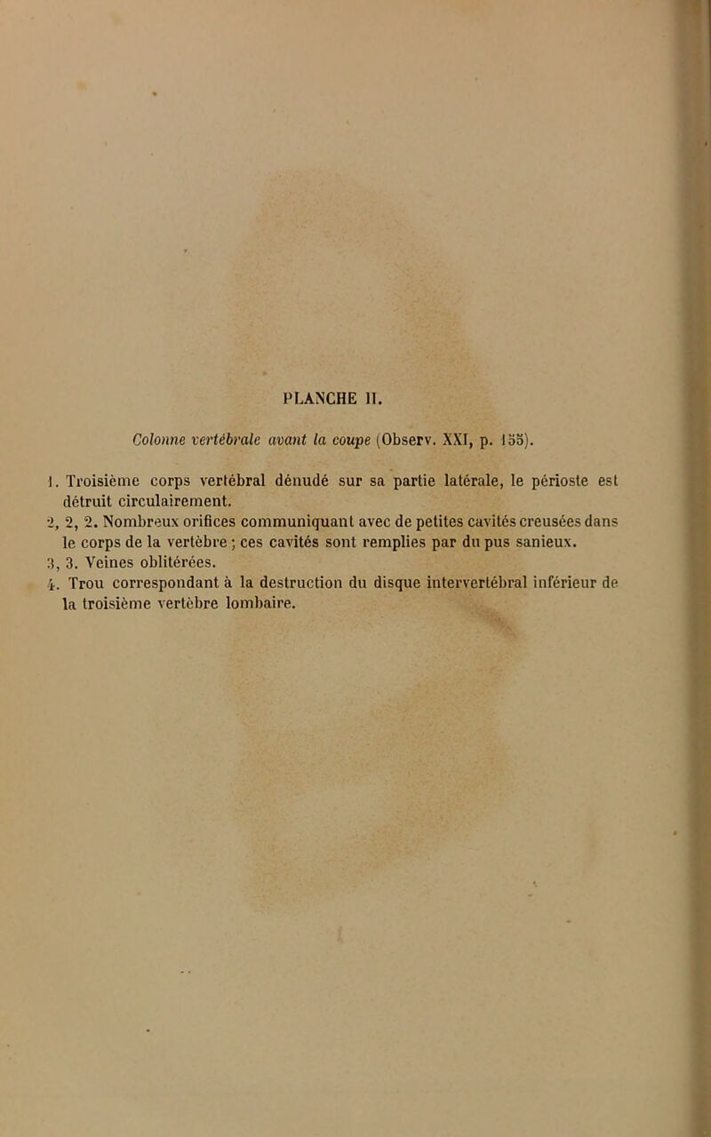 Colonne vertébrale avant la coupe (Observ. XXI, p. loo). 1, Troisième corps vertébral dénudé sur sa partie latérale, le périoste est détruit circulairement. 2, 2, 2. Nombreux orifices communiquant avec de petites cavités creusées dans le corps de la vertèbre ; ces cavités sont remplies par du pus sanieux. 3, 3. Veines oblitérées. i. Trou correspondant à la destruction du disque intervertébral inférieur de la troisième vertèbre lombaire.