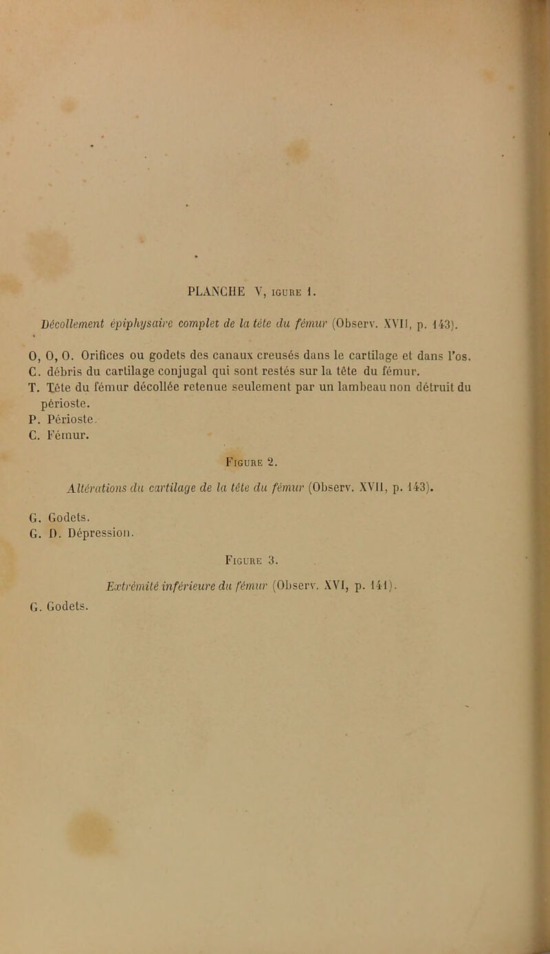 Décollement êpiphysaire complet de la tète du fémur (Observ. XVII, p. 143). O, O, O. Orifices ou godets des canaux creusés dans le cartilage et dans l’os. C. débris du cartilage conjugal qui sont restés sur la tête du fémur. T. Tête du fémur décollée retenue seulement par un lambeau non détruit du périoste. P. Périoste. C. Fémur. Figure 2. Altérations du cartilage de la tête du fémur (Observ. XVII, p. 143). G. Godets. G. 1). Dépression. Figure 3. Extrémité inférieure du fémur (Observ. XVI, p. 141). G. Godets.
